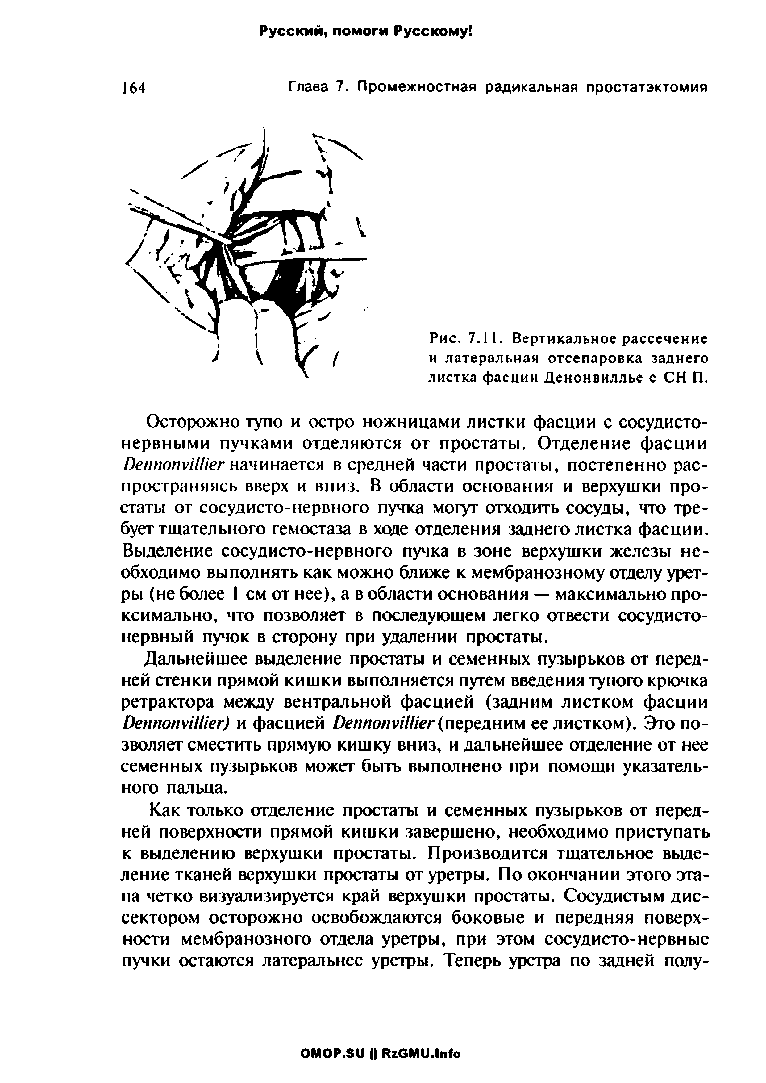 Рис. 7.11. Вертикальное рассечение и латеральная отсепаровка заднего листка фасции Денонвиллье с СН П.