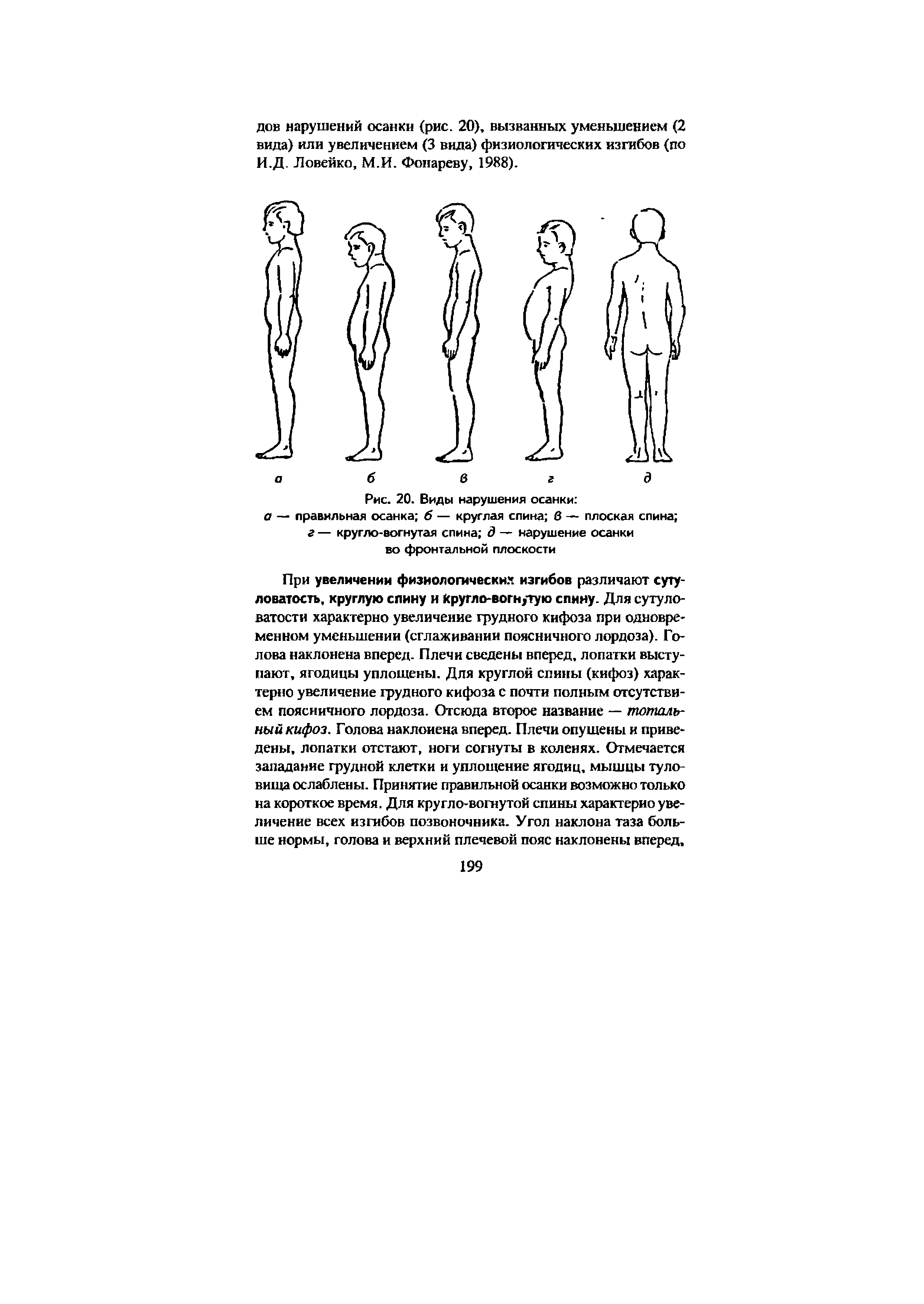 Рис. 20. Виды нарушения осанки а — правильная осанка б — круглая спина в — плоская спина г — кругло-вогнутая спина д — нарушение осанки во фронтальной плоскости...