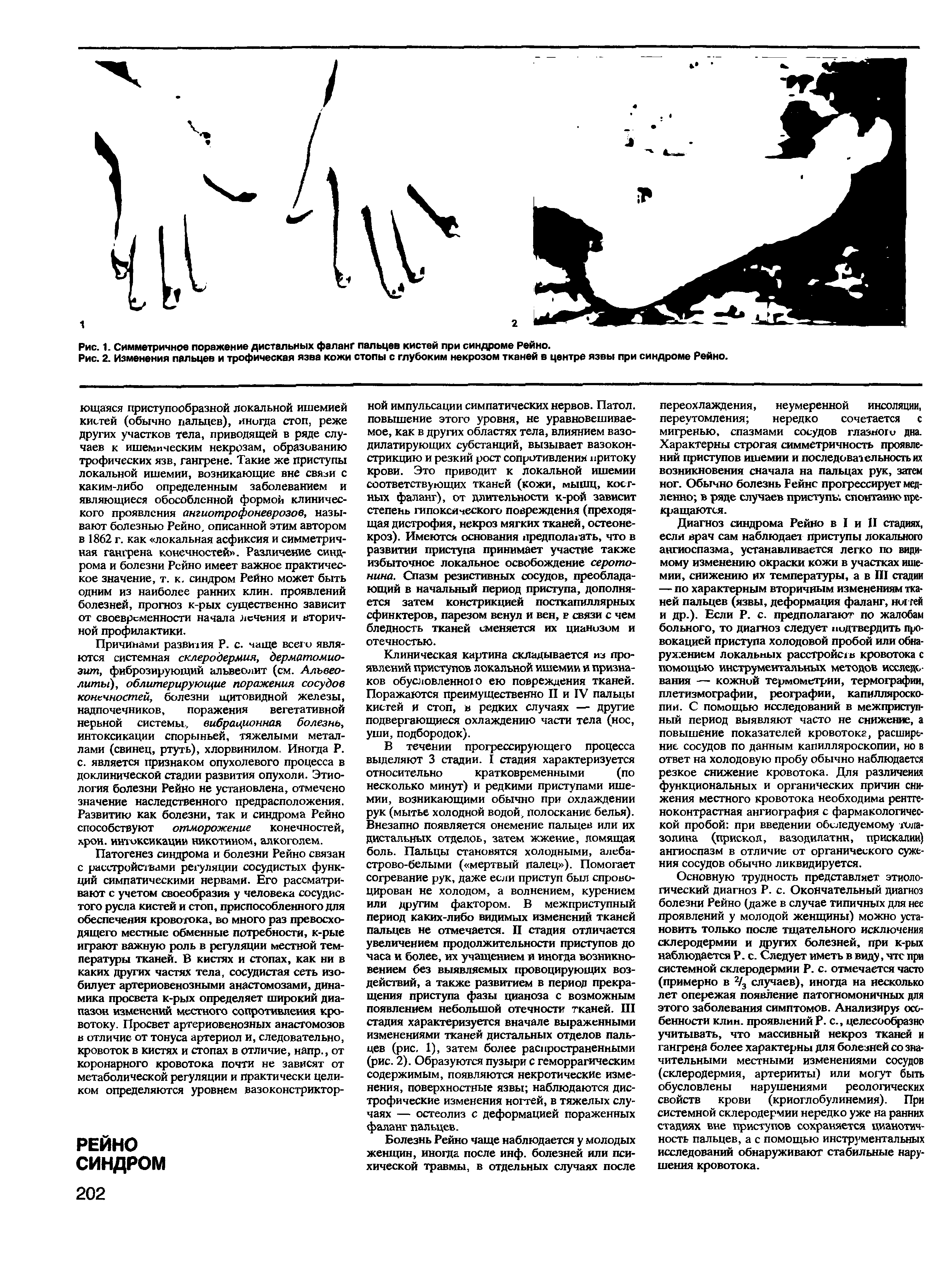 Рис. 1. Симметричное поражение дистальных фаланг пальцев кистей при синдроме Рейно.