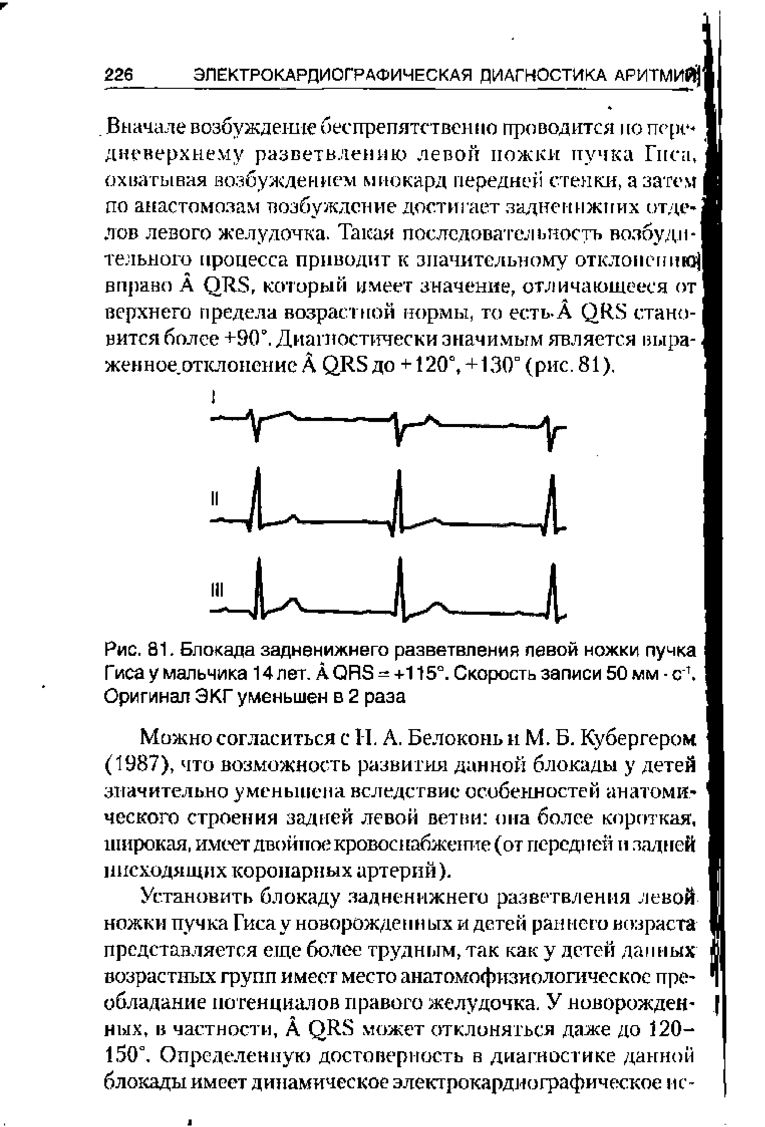 Рис. 81. Блокада задненижнего разветвления левой ножки пучка Гиса у мальчика 14 лет. А ОКБ = +115°. Скорость записи 50 мм - с1. Оригинал ЭКГ уменьшен в 2 раза...