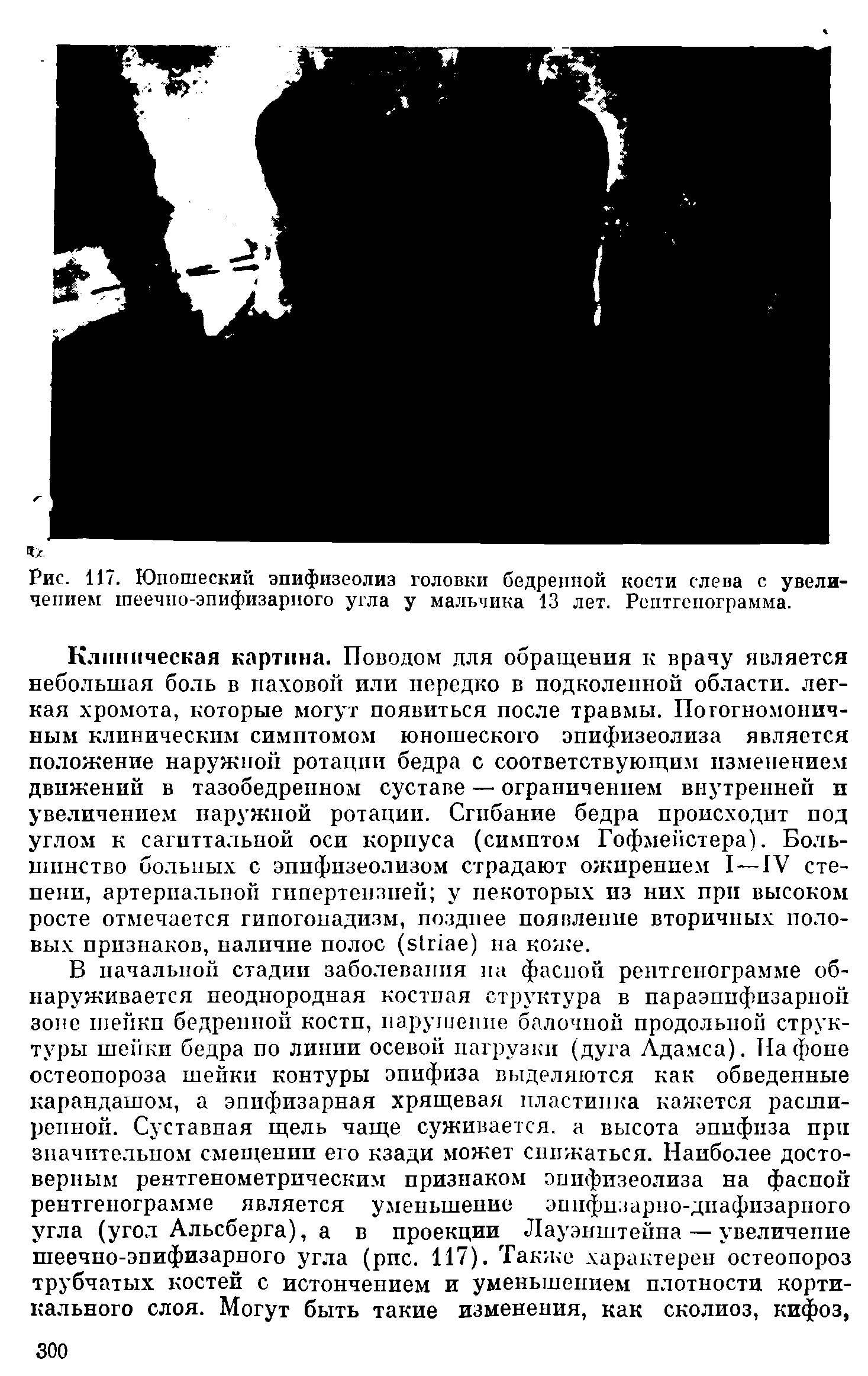 Рис. 117. Юношеский эпифизеолиз головки бедренной кости слева с увеличением шеечно-эпифизарного угла у мальчика 13 лет. Рентгенограмма.