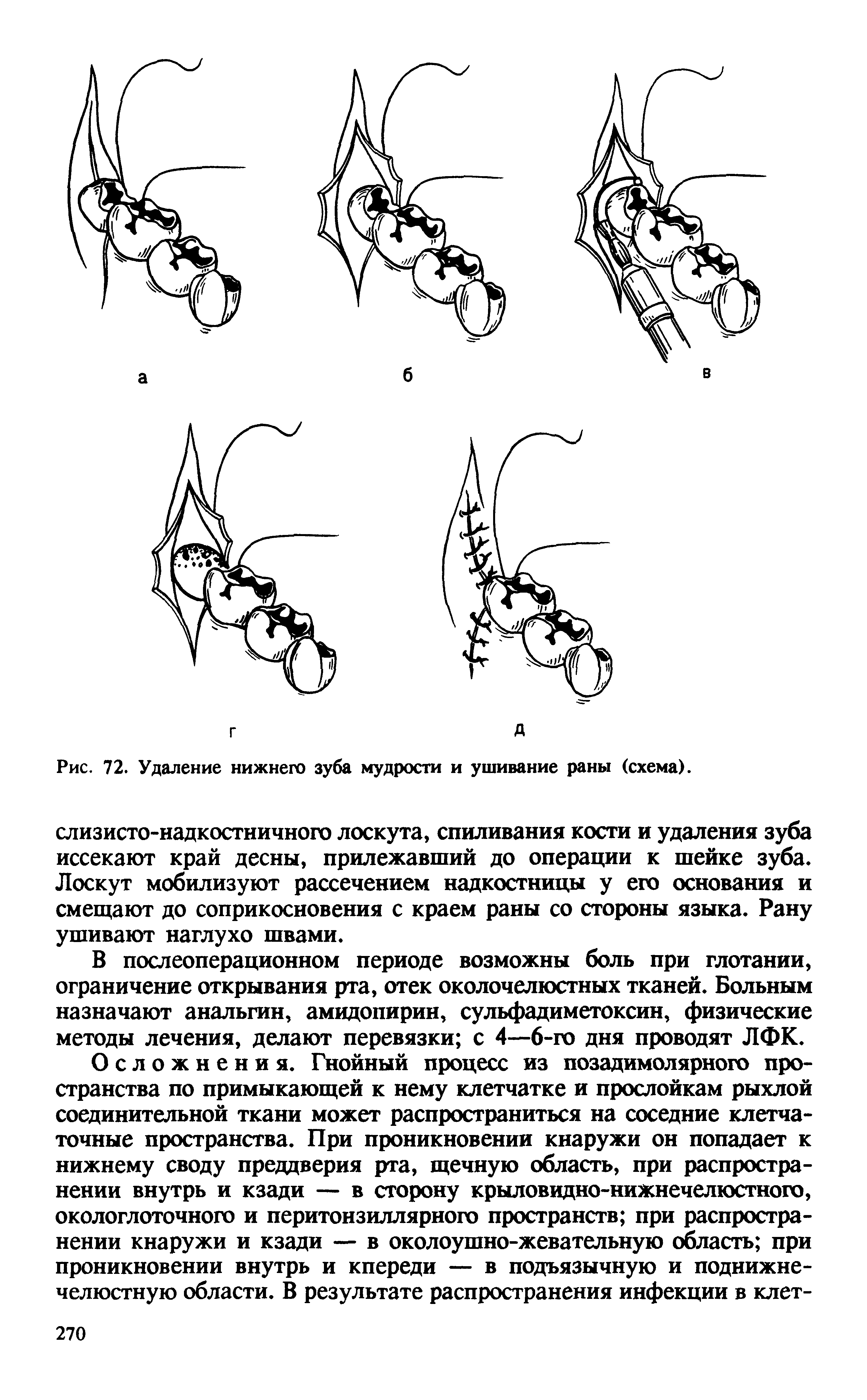 Удалены нижние. Схема выдергивания зуба. Процесс вырывания зуба.