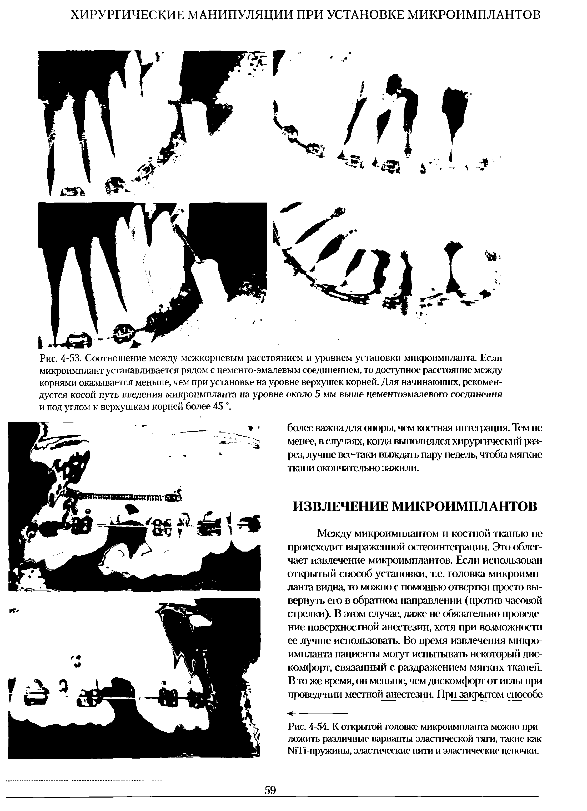 Рис. 4-54. К открытой головке микроимпланта можно приложить различные варианты эластической тяги, такие как №Т -пружины, эластические нити и эластические цепочки.