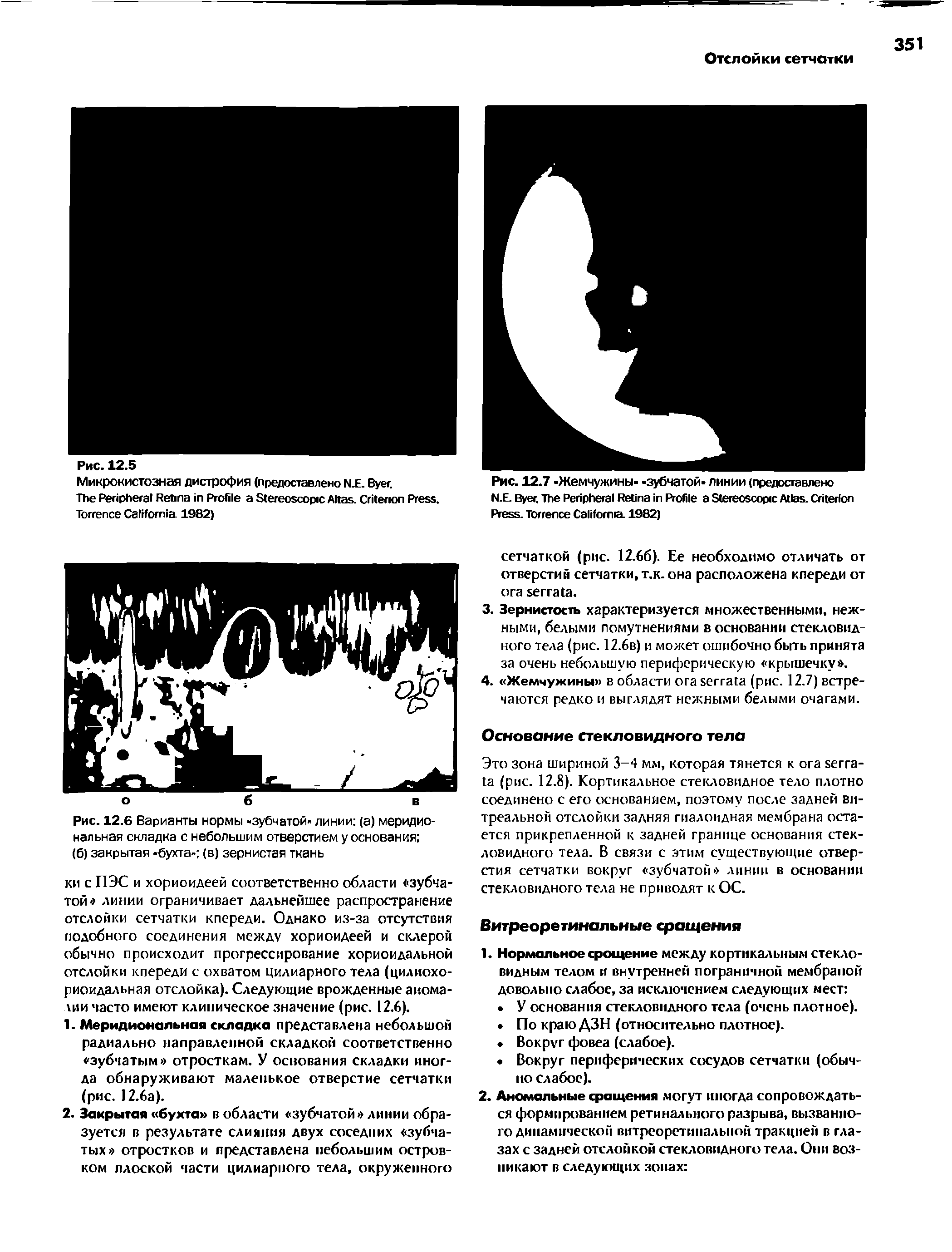 Рис. 12.6 Варианты нормы -зубчатой- линии (а) меридиональная складка с небольшим отверстием у основания (б) закрытая -бухта- (в) зернистая ткань...