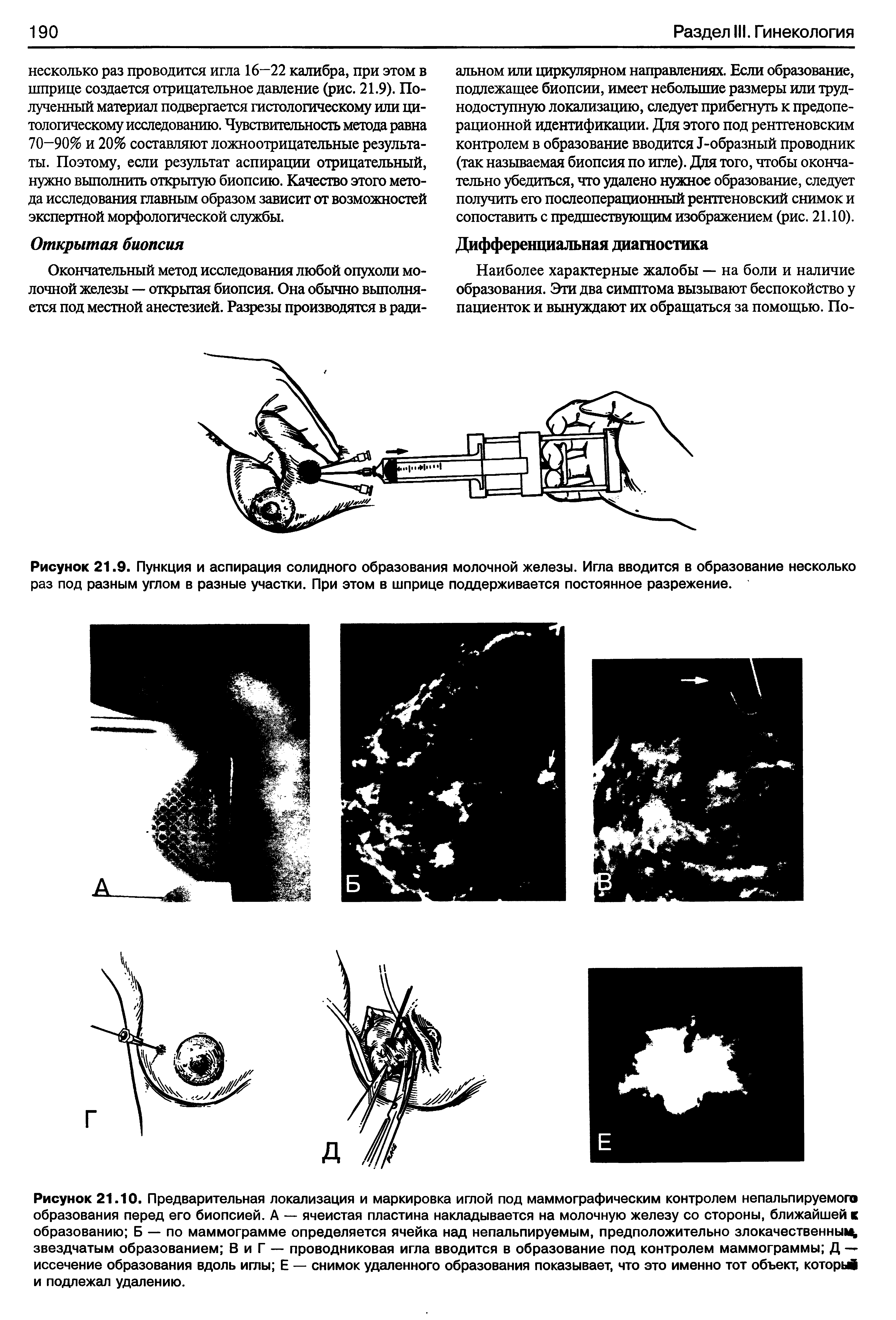 Рисунок 21.9. Пункция и аспирация солидного образования молочной железы. Игла вводится в образование несколько раз под разным углом в разные участки. При этом в шприце поддерживается постоянное разрежение.