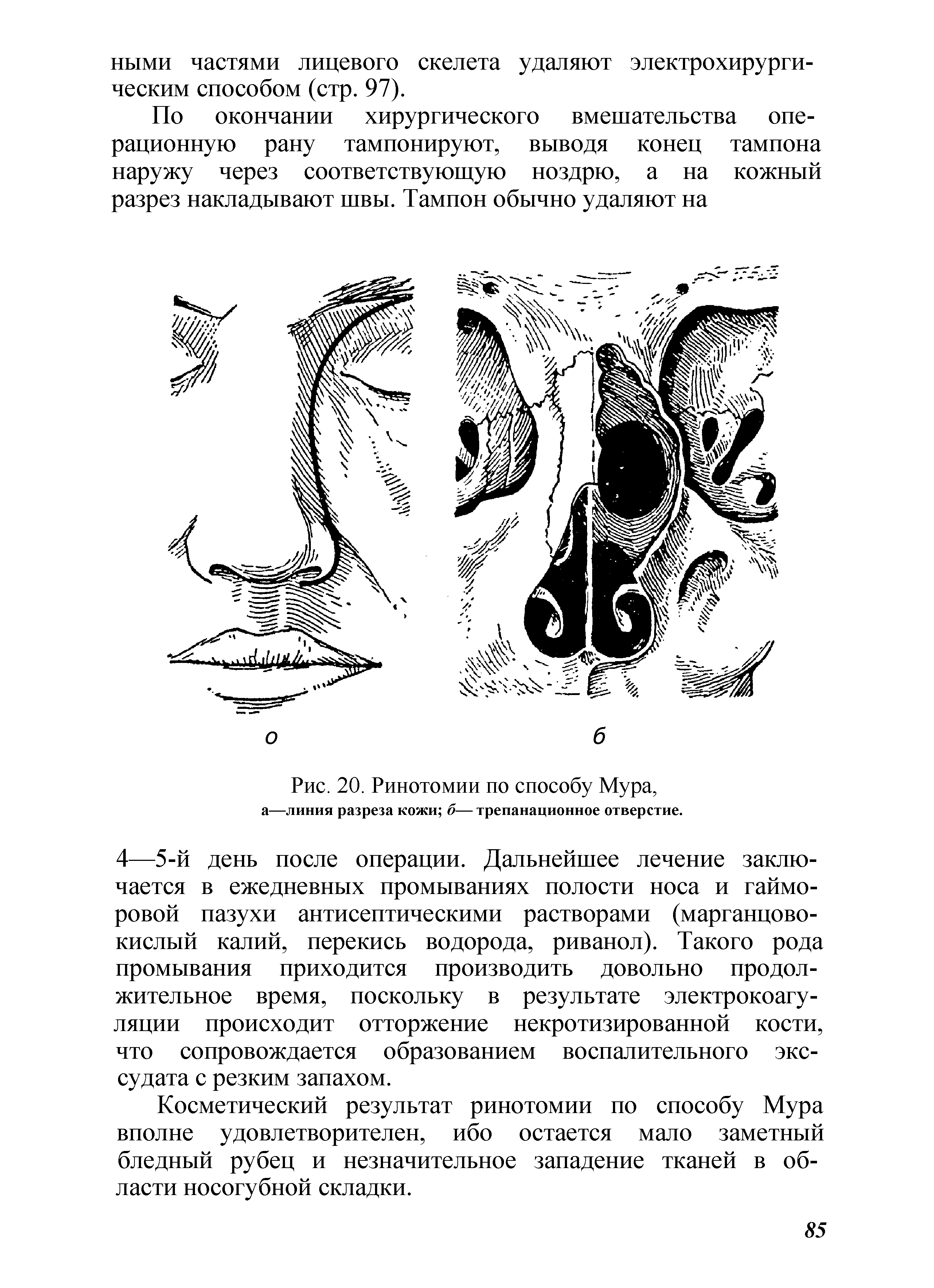 Рис. 20. Ринотомии по способу Мура, а—линия разреза кожи б— трепанационное отверстие.