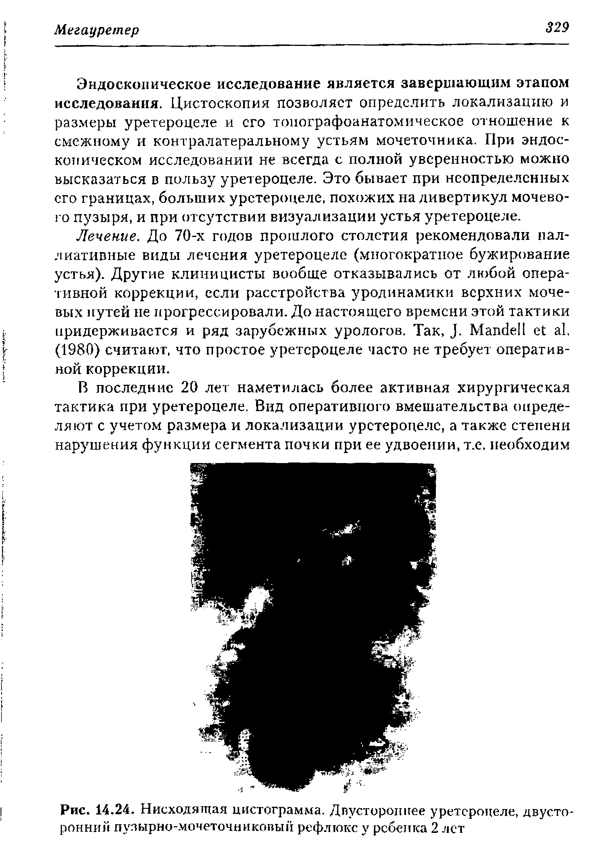 Рис. 14.24. Нисходящая цистограмма. Двустороннее уретероцеле, двусторонний пузырно-мочеточниковый рефлюкс у ребенка 2 лет...