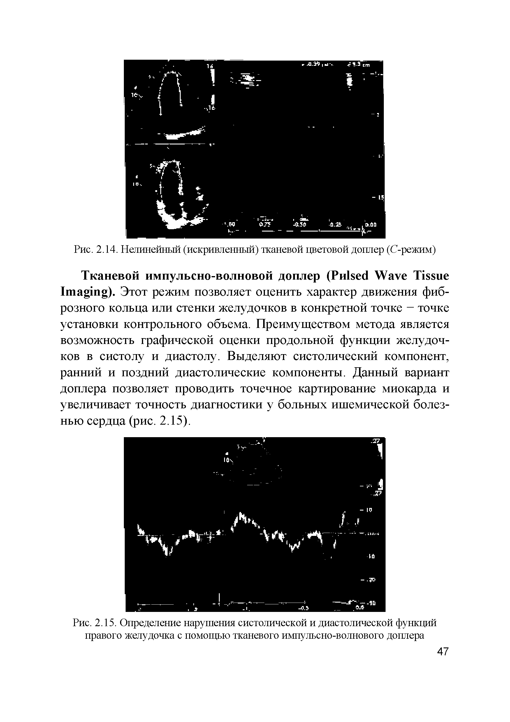 Рис. 2.15. Определение нарушения систолической и диастолической функций правого желудочка с помощью тканевого импульсно-волнового доплера...