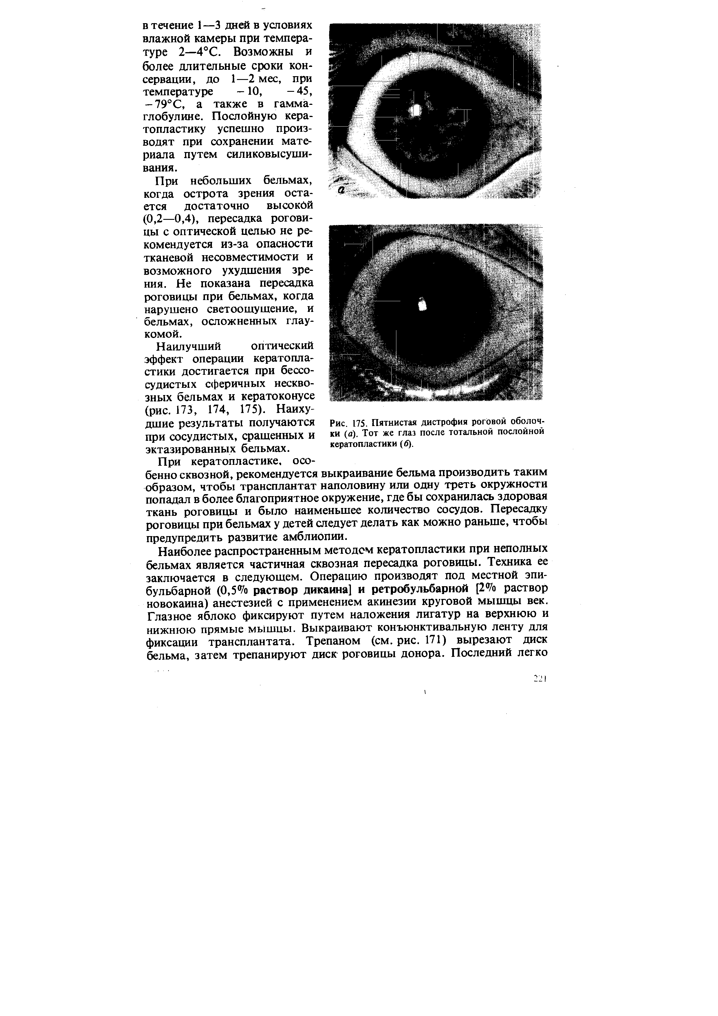 Рис. 175. Пятнистая дистрофия роговой оболочки (а). Тот же глаз после тотальной послойной кератопластики (б).