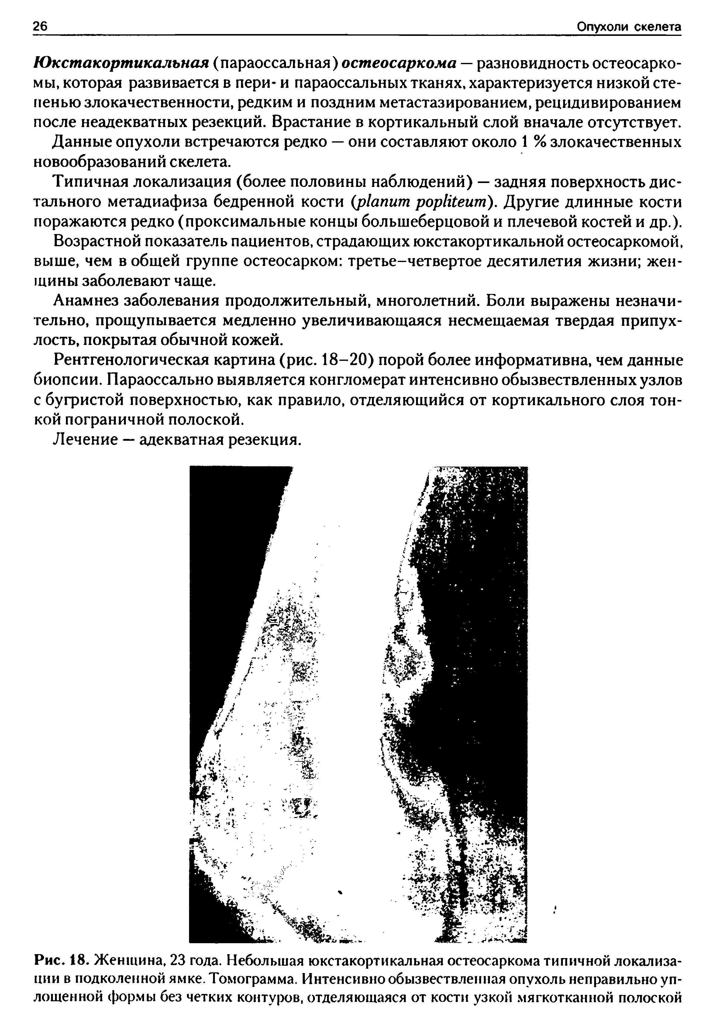 Рис. 18. Женщина, 23 года. Небольшая юкстакортикальная остеосаркома типичной локализации в подколенной ямке. Томограмма. Интенсивно обызвествленная опухоль неправильно уплощенной формы без четких контуров, отделяющаяся от кости узкой мягкотканной полоской...