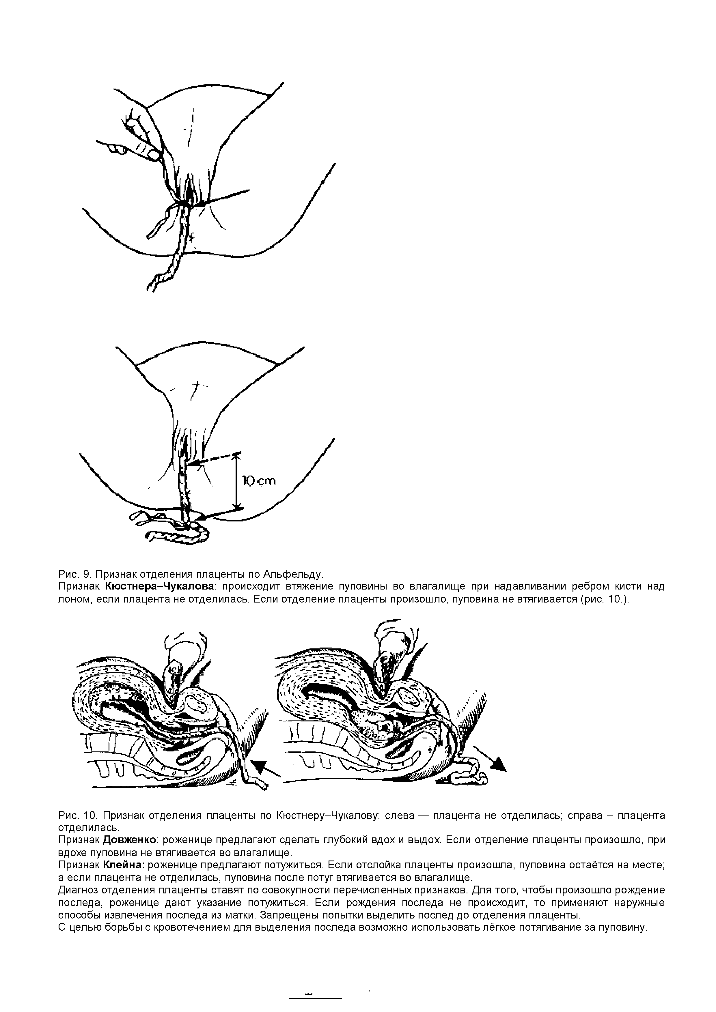Рис. 10. Признак отделения плаценты по Кюстнеру-Чукалову слева— плацента не отделилась справа - плацента отделилась.