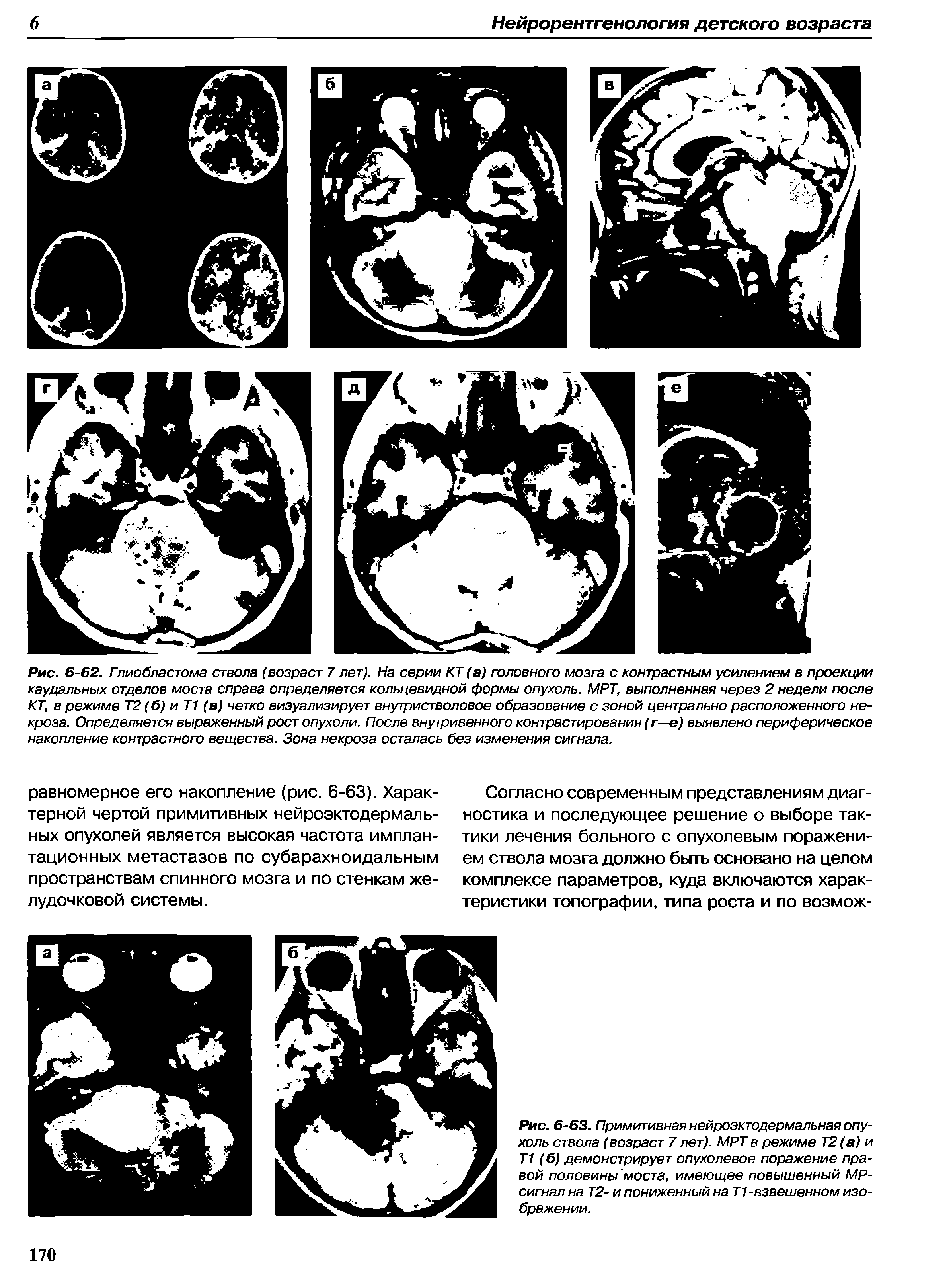 Рис. 6-63. Примитивная нейроэктодермальная опухоль ствола (возраст 7 лет). МРТ в режиме Т2 (а) и Т1 (б) демонстрирует опухолевое поражение правой половины моста, имеющее повышенный МР-сигнал на Т2- и пониженный на Т1-взвешенном изображении.