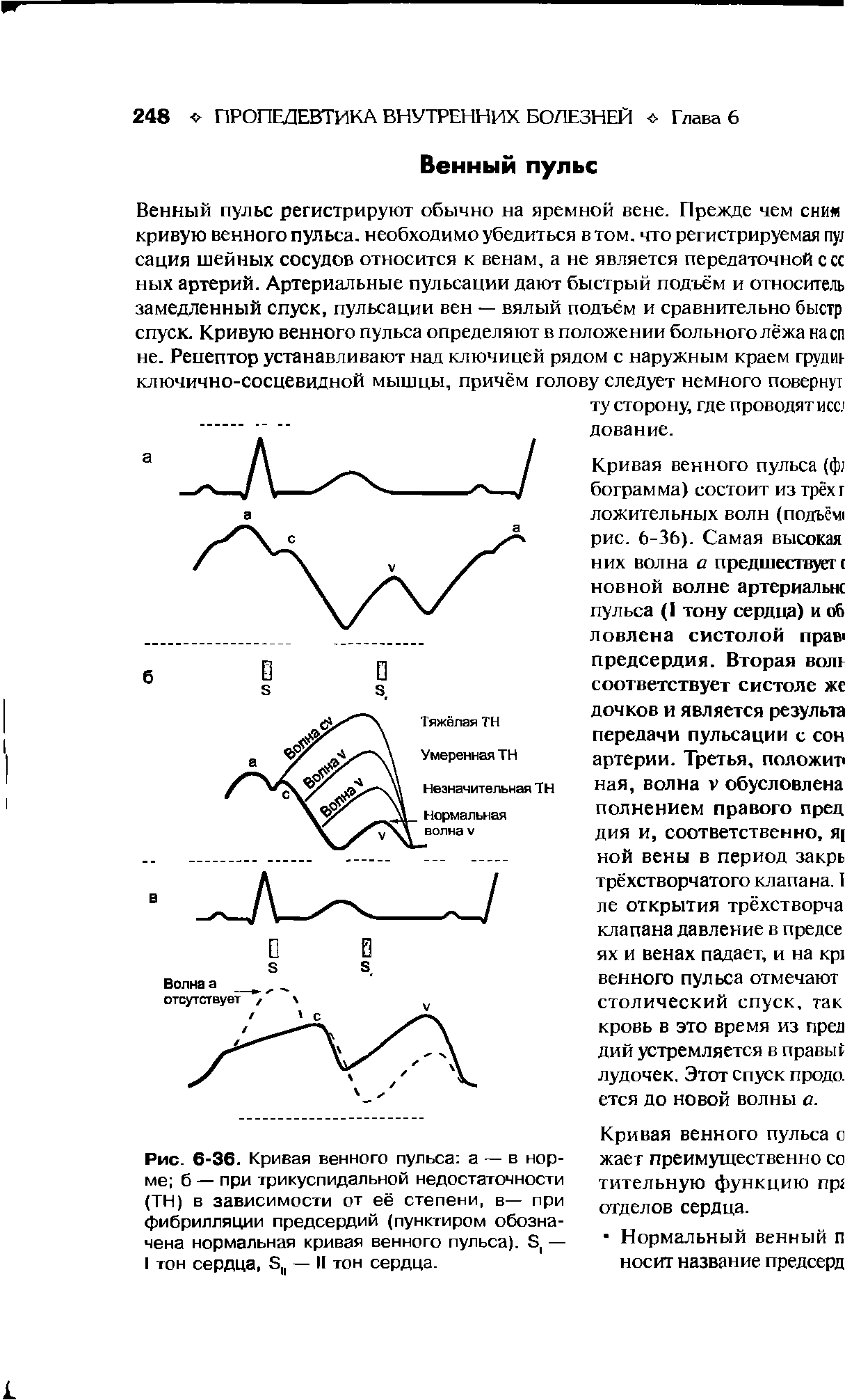 Рис. 6-36. Кривая венного пульса а — в норме б — при трикуспидальной недостаточности (ТН) в зависимости от её степени, в— при фибрилляции предсердий (пунктиром обозначена нормальная кривая венного пульса). 8( — I тон сердца, в, — И тон сердца.