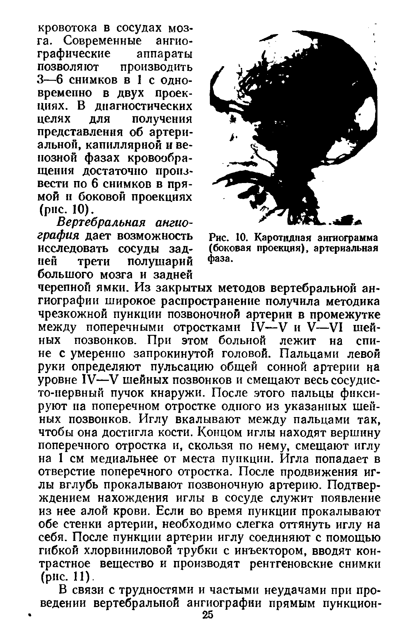 Рис. 10. Каротидная ангиограмма (боковая проекция), артериальная фаза.