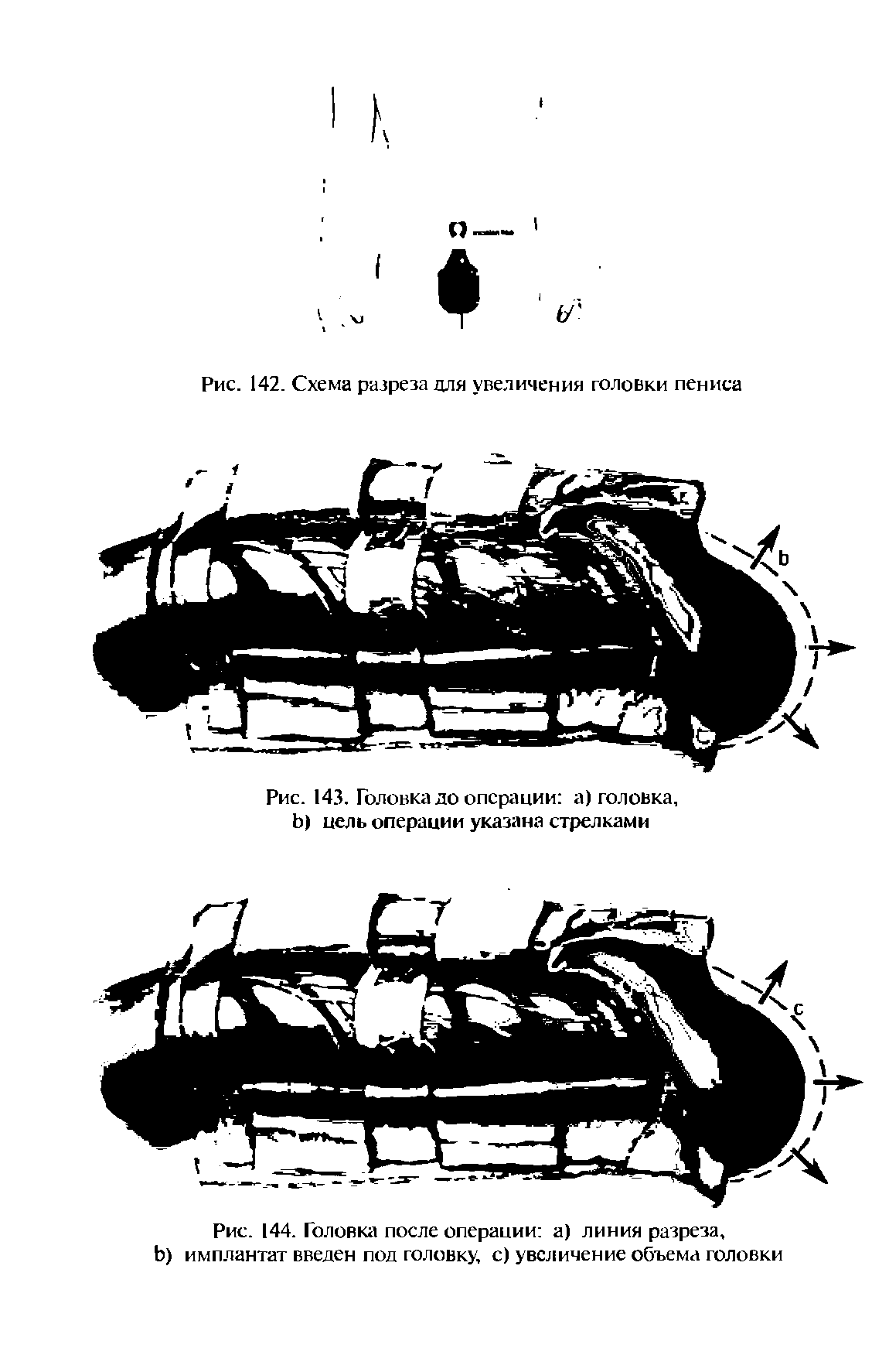 Рис. 144. Головка после операции а) линия разреза, Ь) имплантат введен под головку, с) увеличение объема головки...