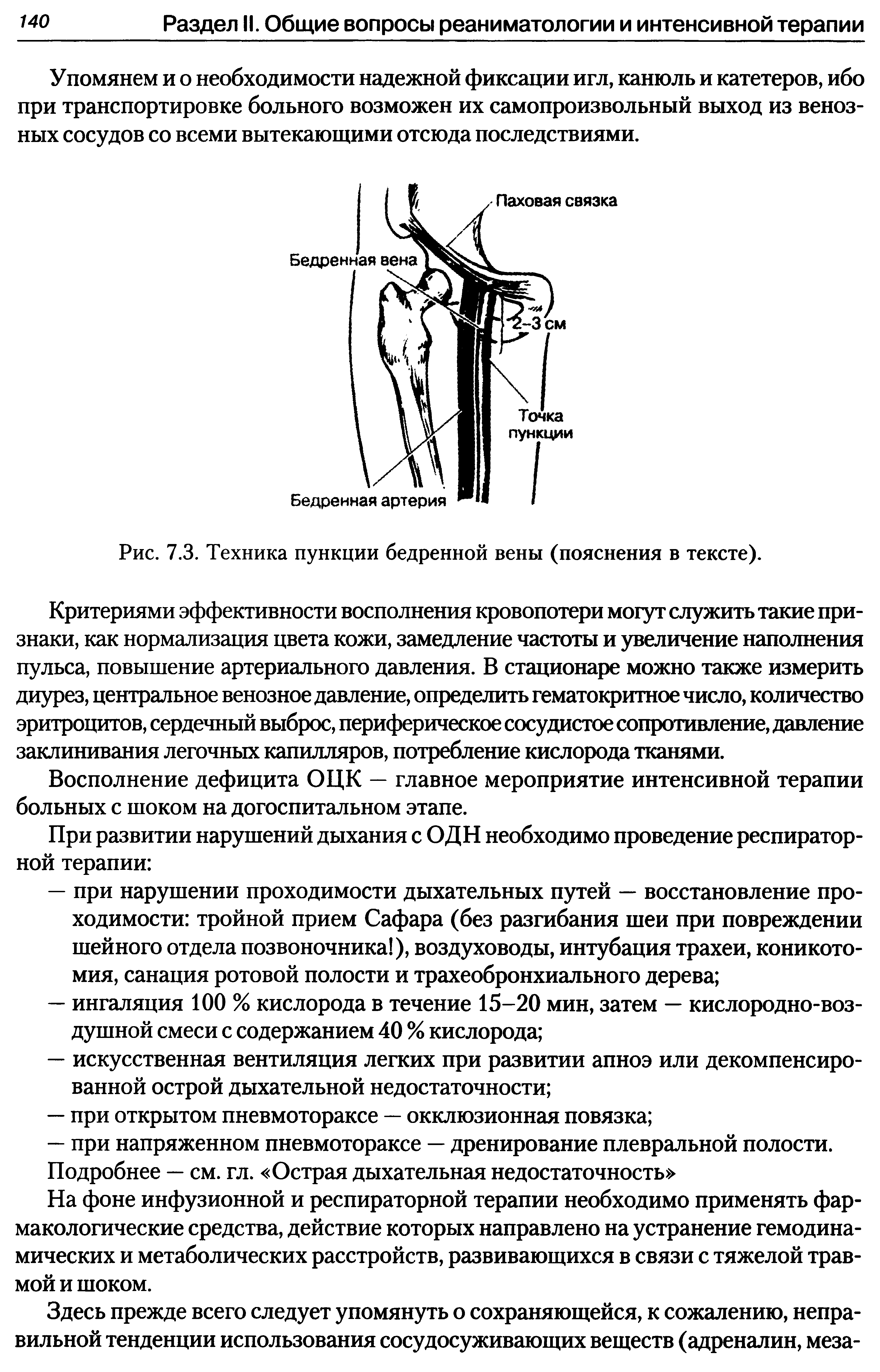 Рис. 7.3. Техника пункции бедренной вены (пояснения в тексте).