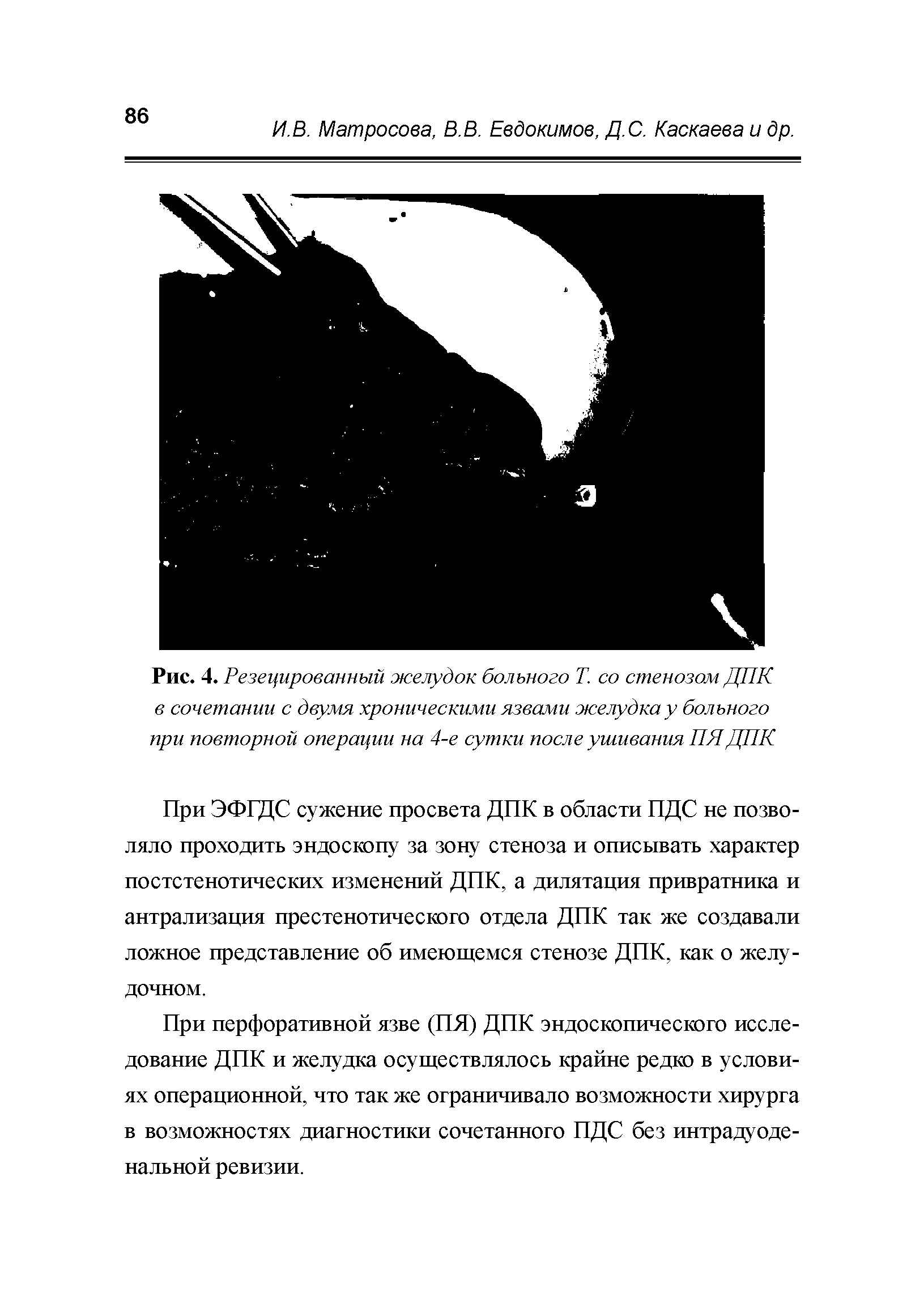 Рис. 4. Резецированный желудок больного Т. со стенозом ДПК в сочетании с двумя хроническими язвами желудка у больного при повторной операции на 4-е сутки после ушивания ПЯДПК...