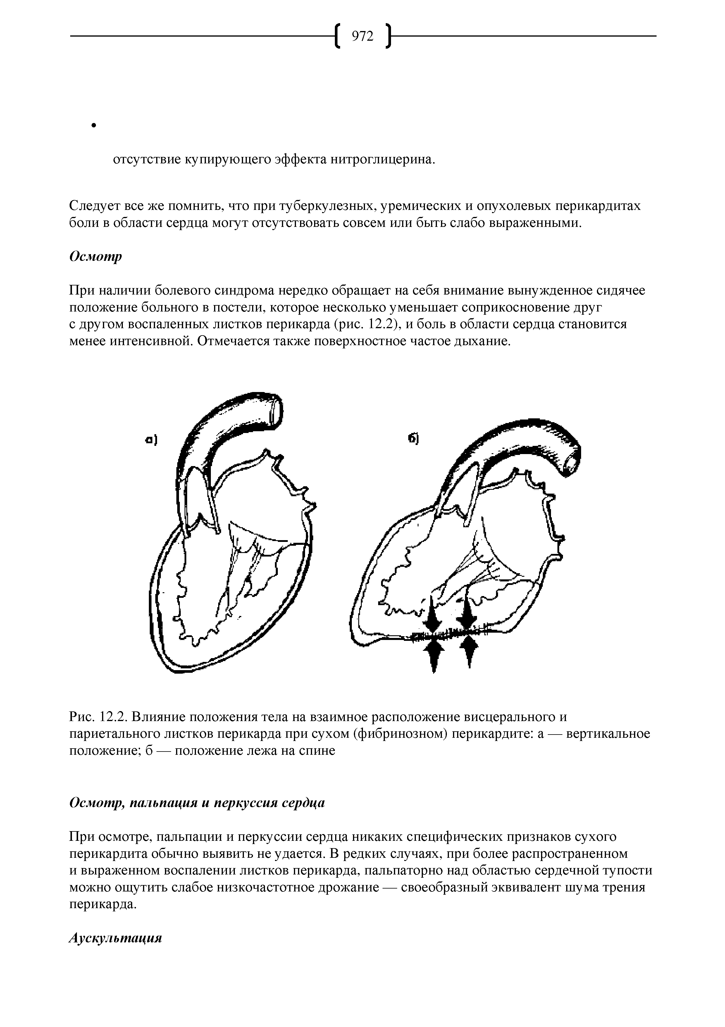 Рис. 12.2. Влияние положения тела на взаимное расположение висцерального и париетального листков перикарда при сухом (фибринозном) перикардите а — вертикальное положение б — положение лежа на спине...