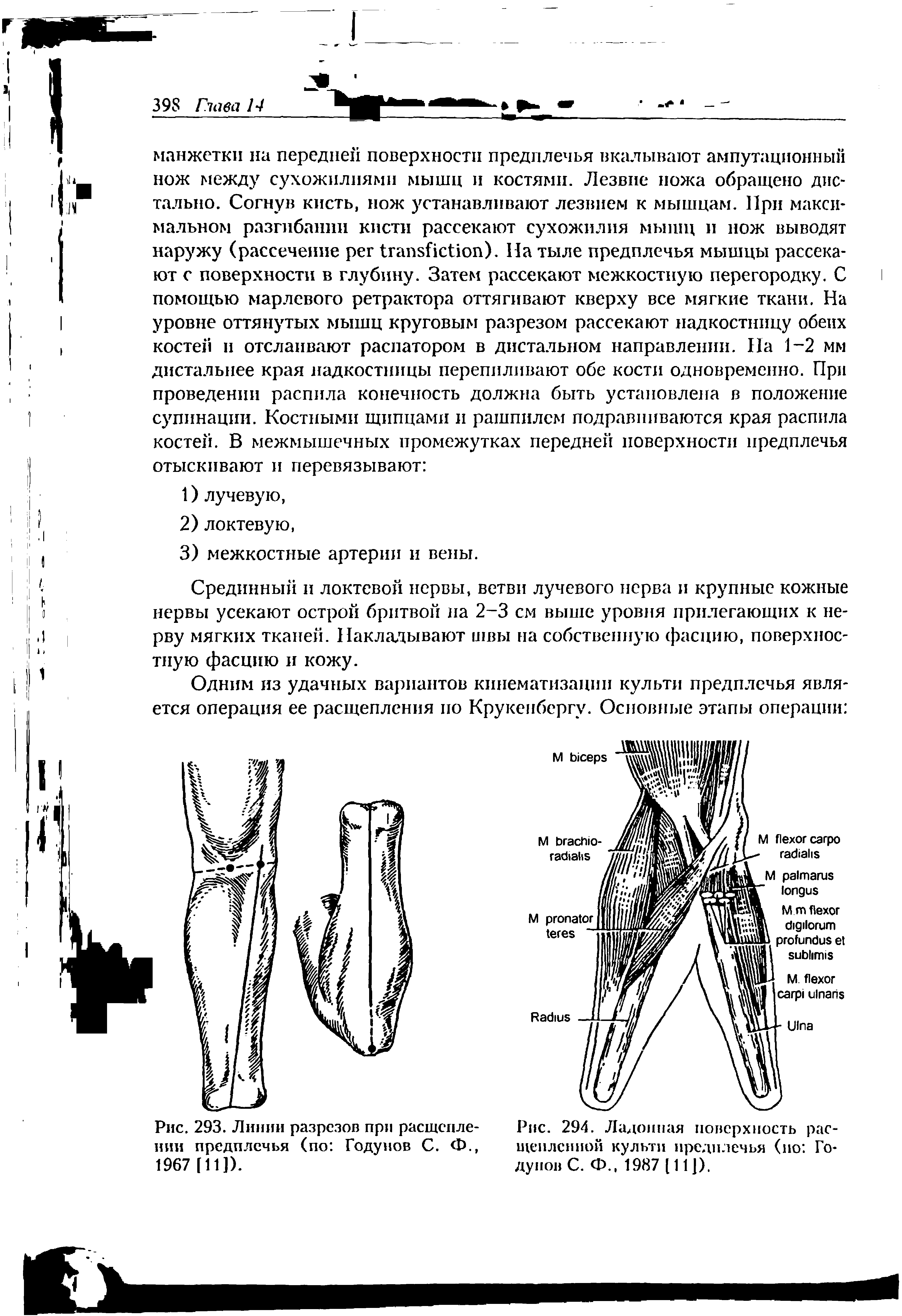 Рис. 294. Ладонная поверхность расщепленной культи предплечья (но Годунов С. Ф., 1987 [11]).