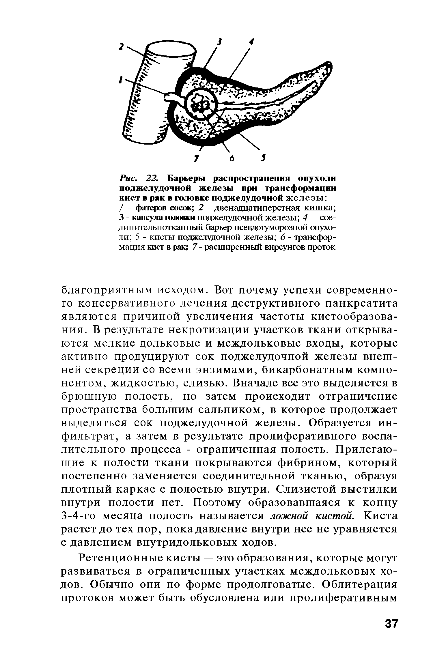 Рис. 22. Барьеры распространения опухоли поджелудочной железы при трансформации кист в рак в головке поджелудочной железы / - фатеров сосок 2 - двенадцатиперстная кишка ...