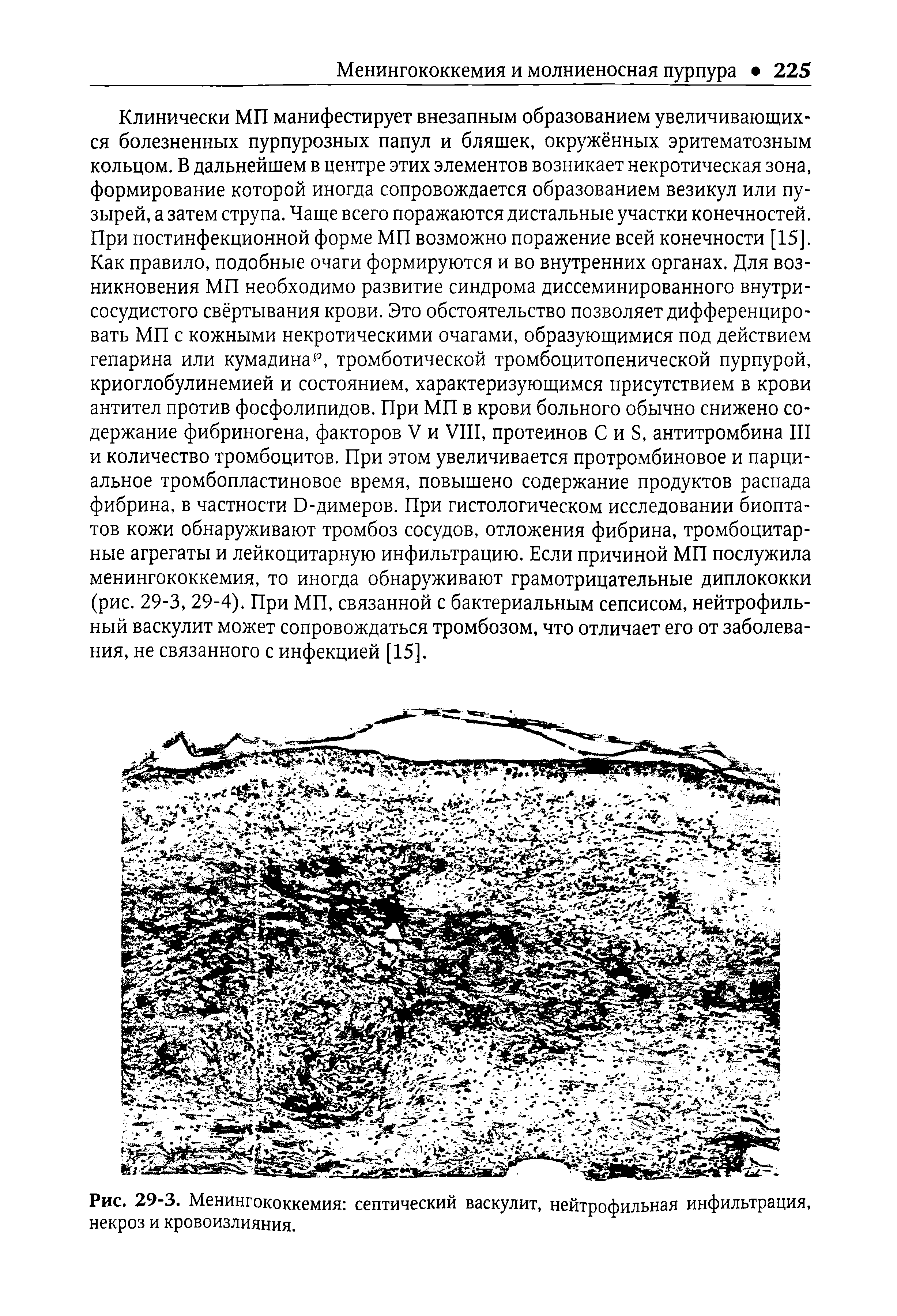 Рис. 29-3. Менингококкемия септический васкулит, нейтрофильная инфильтрация, некроз и кровоизлияния.