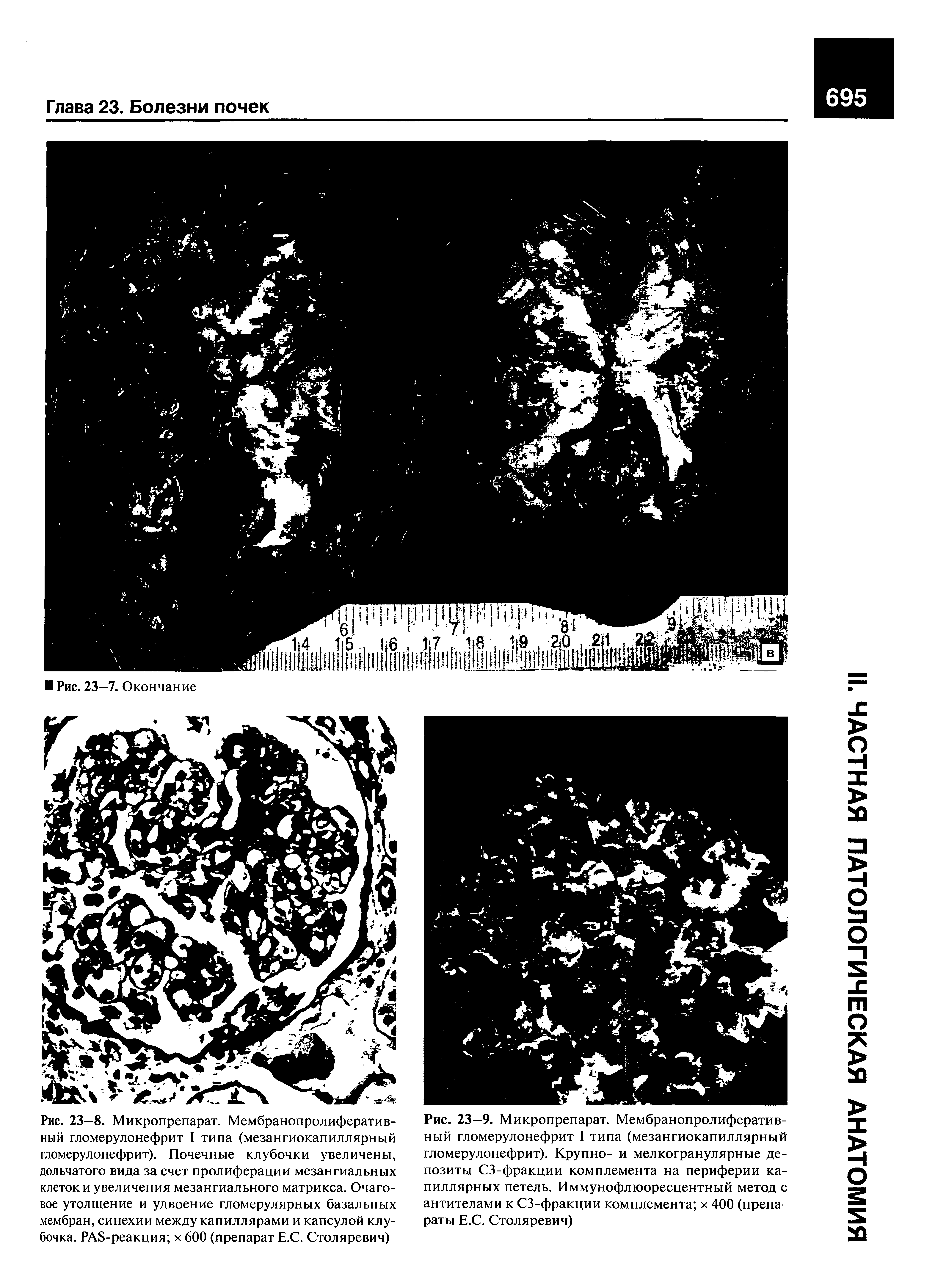 Рис. 23—9. Микропрепарат. Мембранопролиферативный гломерулонефрит I типа (мезангиокапиллярный гломерулонефрит). Крупно- и мелкогранулярные депозиты СЗ-фракции комплемента на периферии капиллярных петель. Иммунофлюоресцентный метод с антителами к СЗ-фракции комплемента х 400 (препараты Е.С. Столяревич)...
