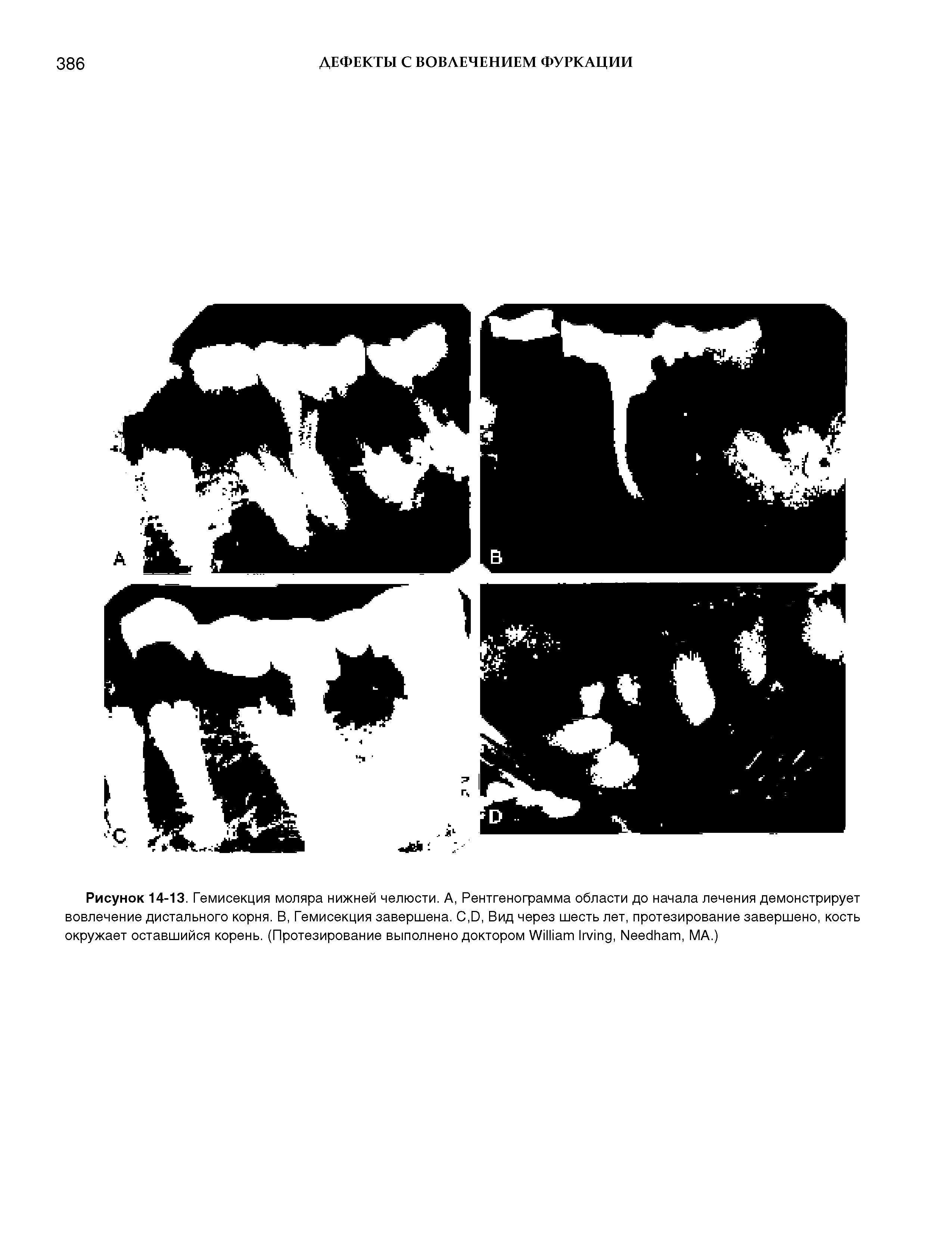 Рисунок 14-13. Гемисекция моляра нижней челюсти. А, Рентгенограмма области до начала лечения демонстрирует вовлечение дистального корня. В, Гемисекция завершена. C,D, Вид через шесть лет, протезирование завершено, кость окружает оставшийся корень. (Протезирование выполнено доктором W I , N , MA.)...
