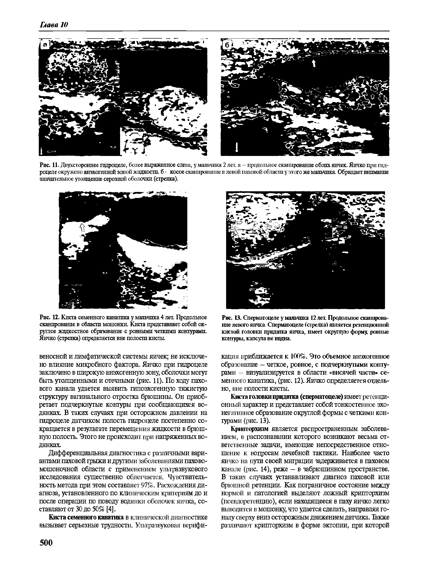 Рис. 12. Киста семенного канатика у мальчика 4 лет. Продольное сканирование в области мошонки. Киста представляет собой округлое жидкостное образование с ровными четкими контурами. Яичко (стрелка) определяется вне полости кисты.