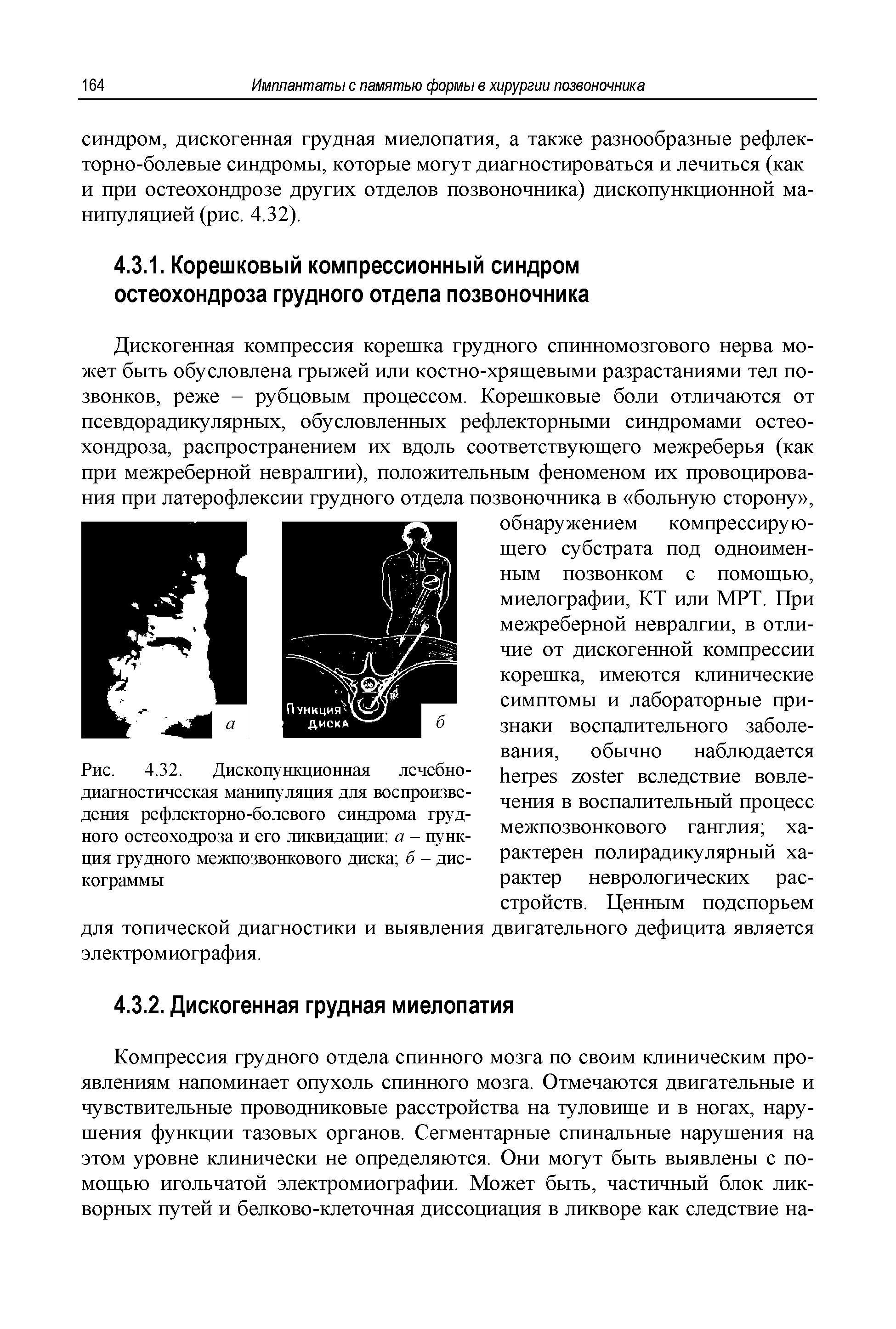 Рис. 4.32. Дископункционная лечебнодиагностическая манипуляция для воспроизведения рефлекторно-болевого синдрома грудного остеоходроза и его ликвидации а - пункция грудного межпозвонкового диска б - дискограммы...