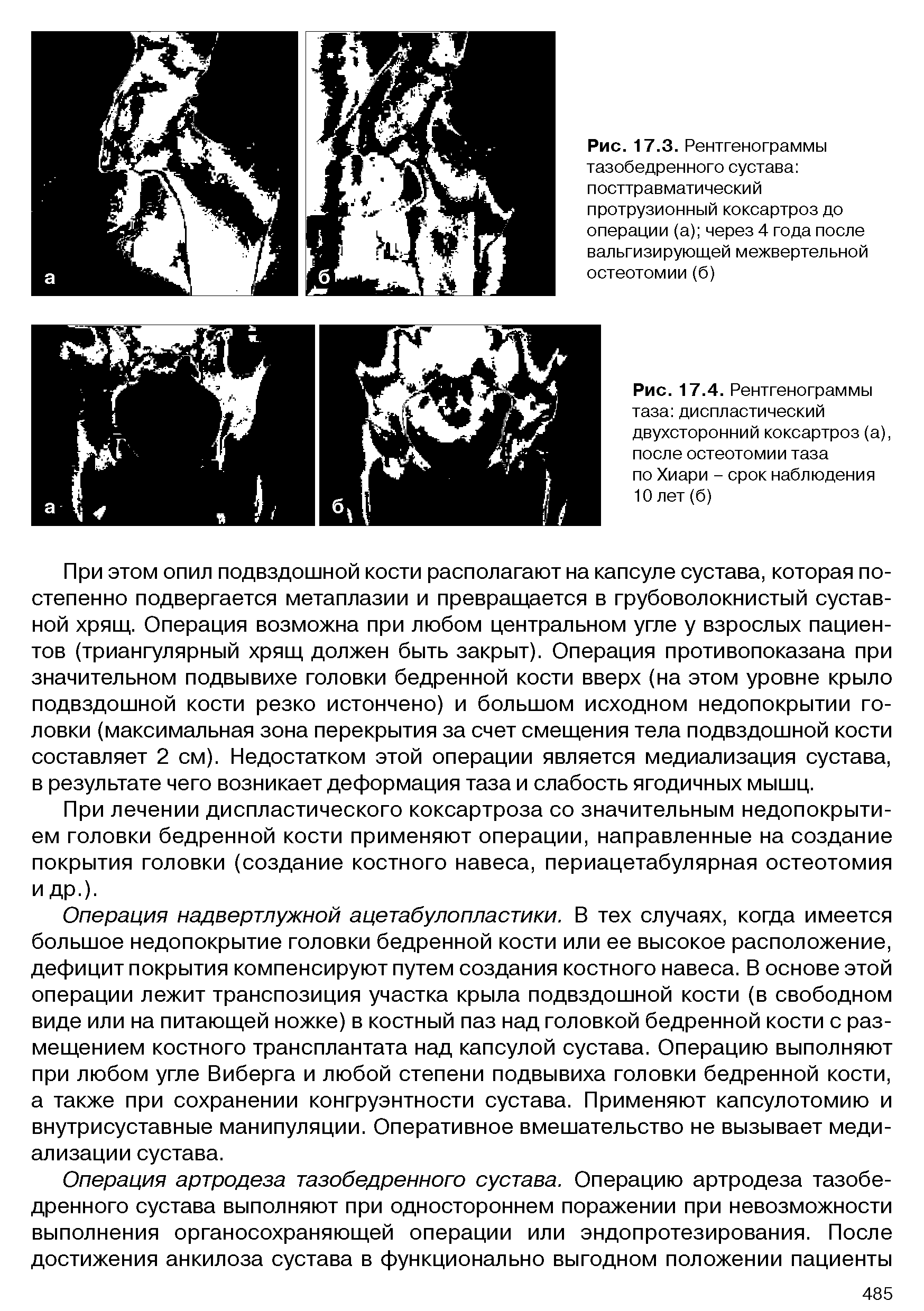 Рис. 17.4. Рентгенограммы таза диспластический двухсторонний коксартроз (а) после остеотомии таза по Хиари - срок наблюдения 10 лет (б)...