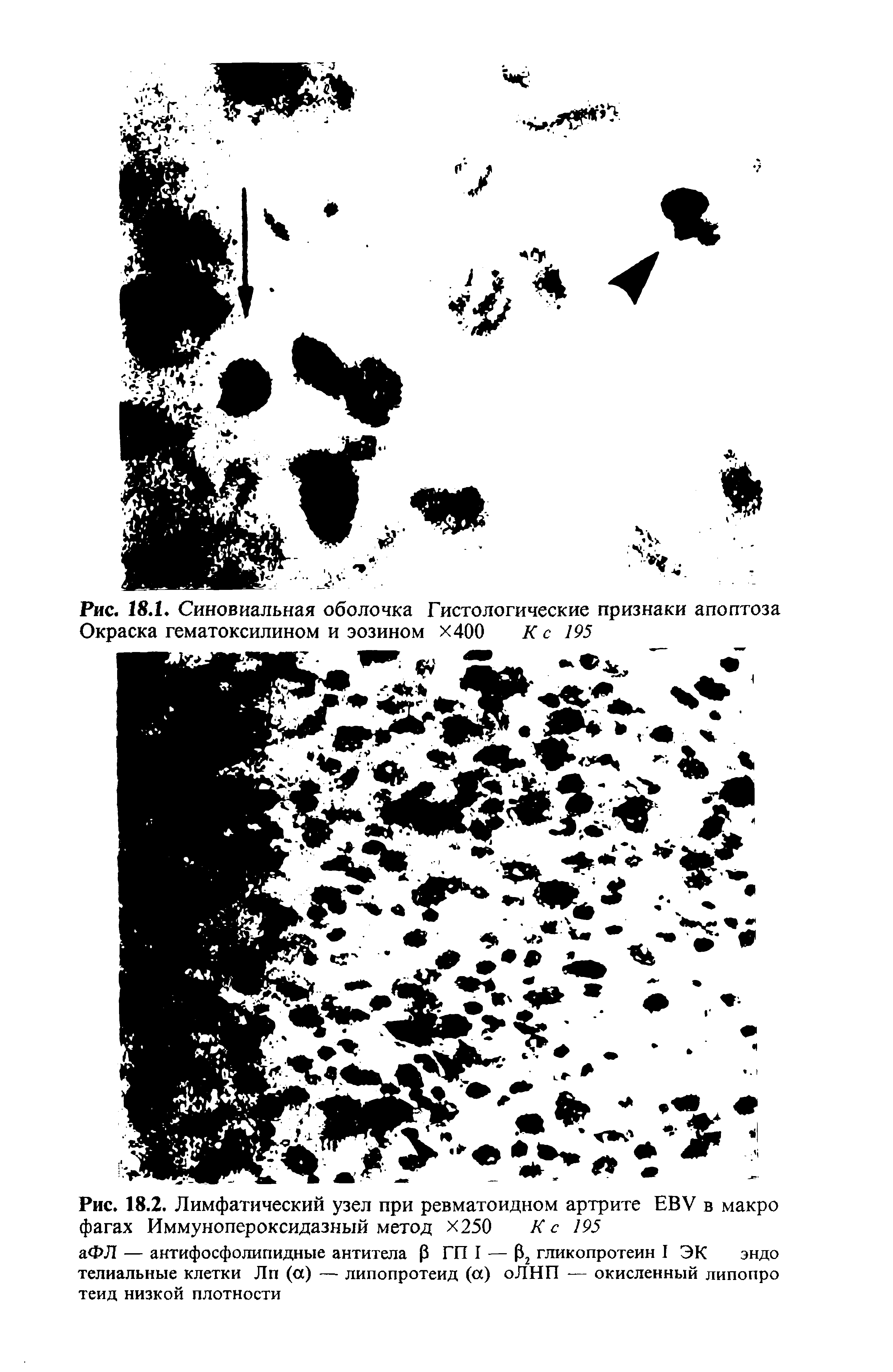 Рис. 18.2. Лимфатический узел при ревматоидном артрите ЕВУ в макро фагах Иммунопероксидазный метод Х250 К с 195...