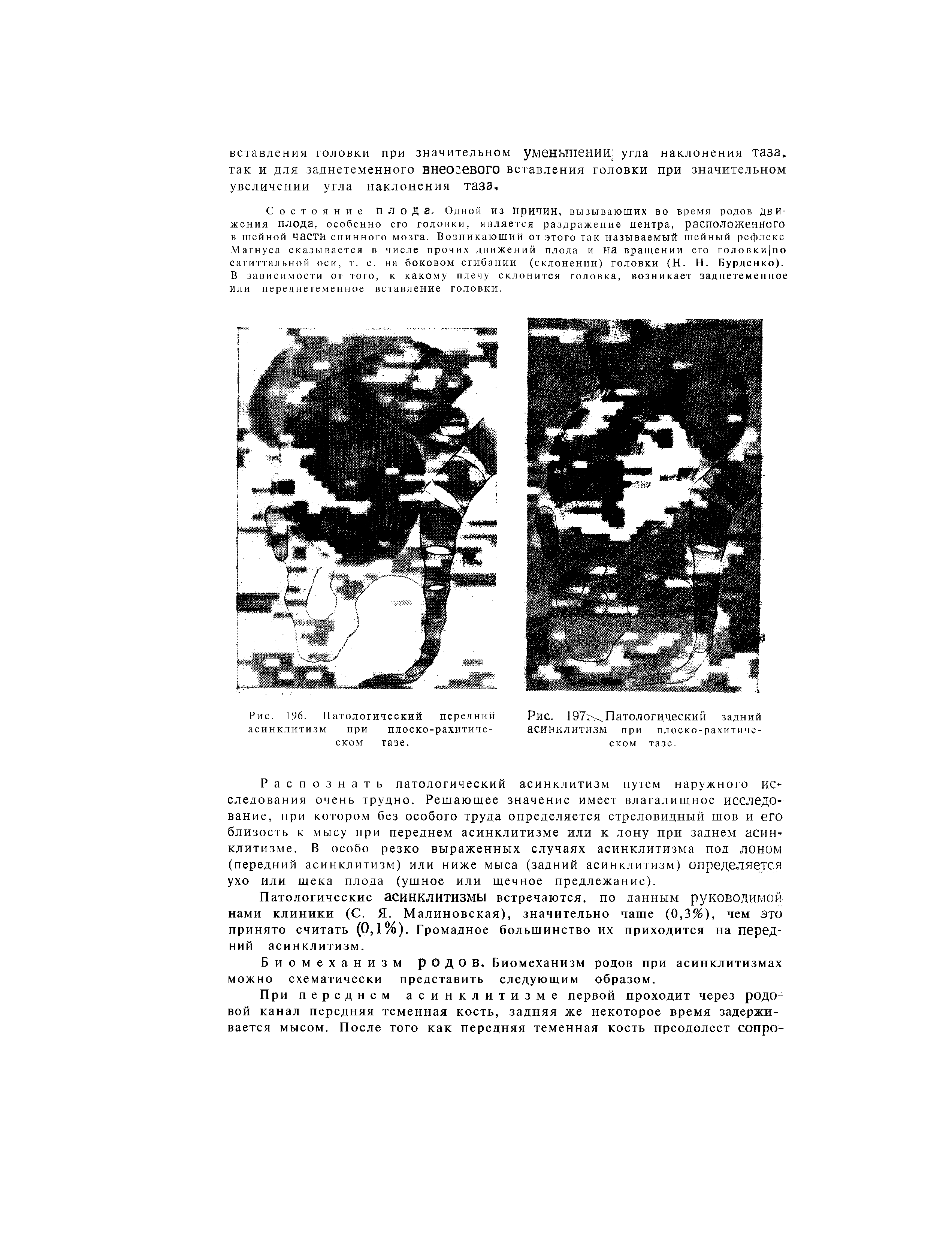 Рис. 196. Патологический передний асинклитизм при плоско-рахитическом тазе.