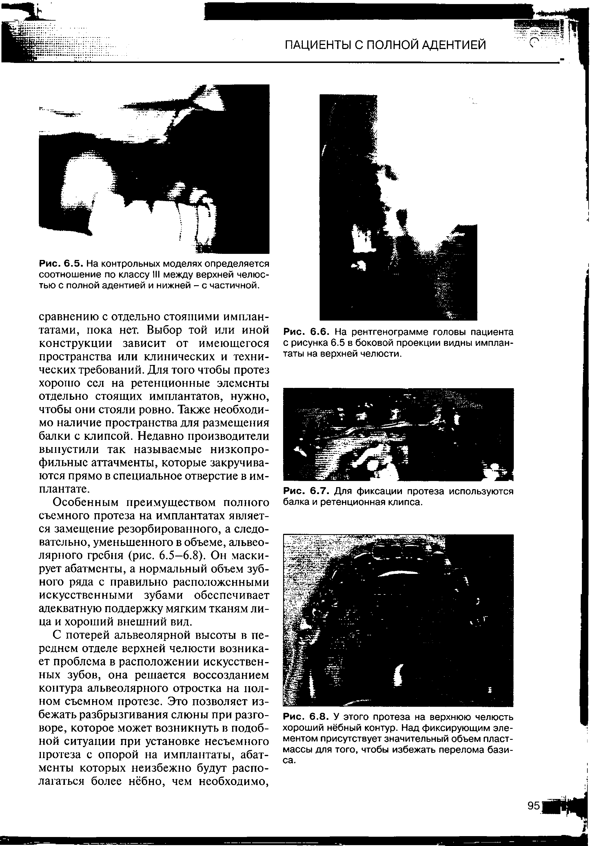 Рис. 6.5. На контрольных моделях определяется соотношение по классу III между верхней челюстью с полной адентией и нижней - с частичной.