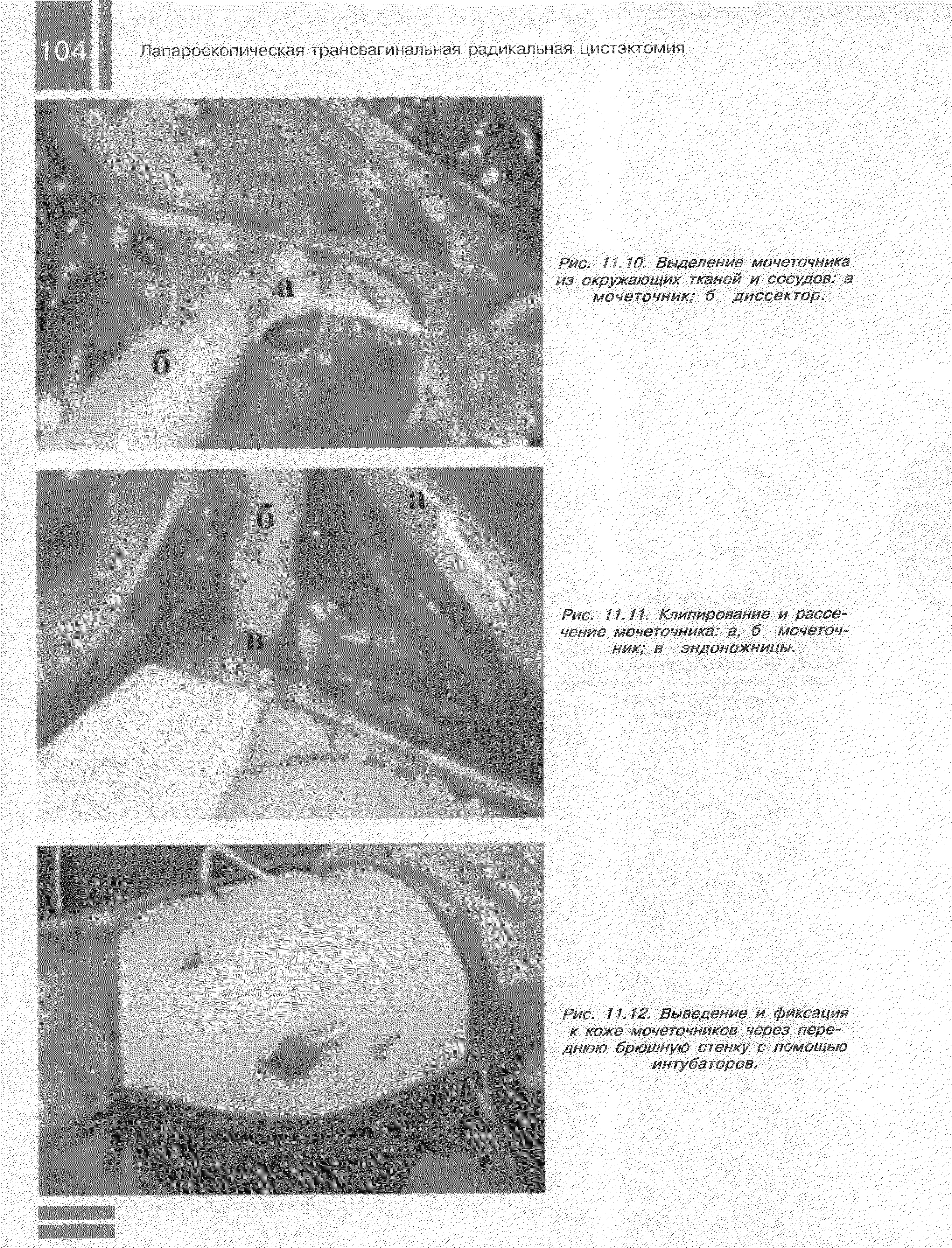 Рис. 11.10. Выделение мочеточника из окружающих тканей и сосудов а мочеточник б диссектор.