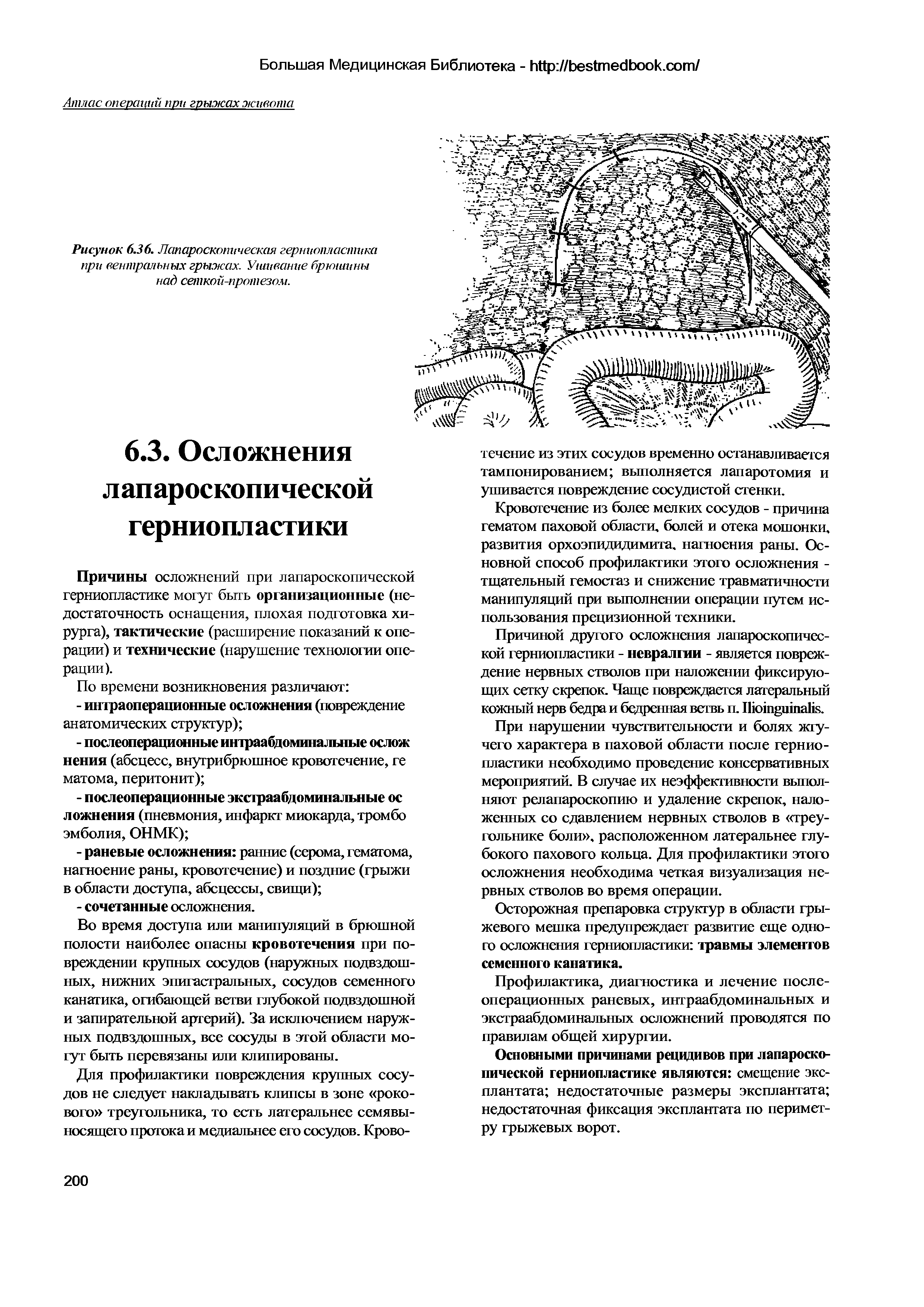 Рисунок 6.36. Лапароскопическая герниопластики при вентральных грыжах. Ушивание брюшины над сеткой-протезом.