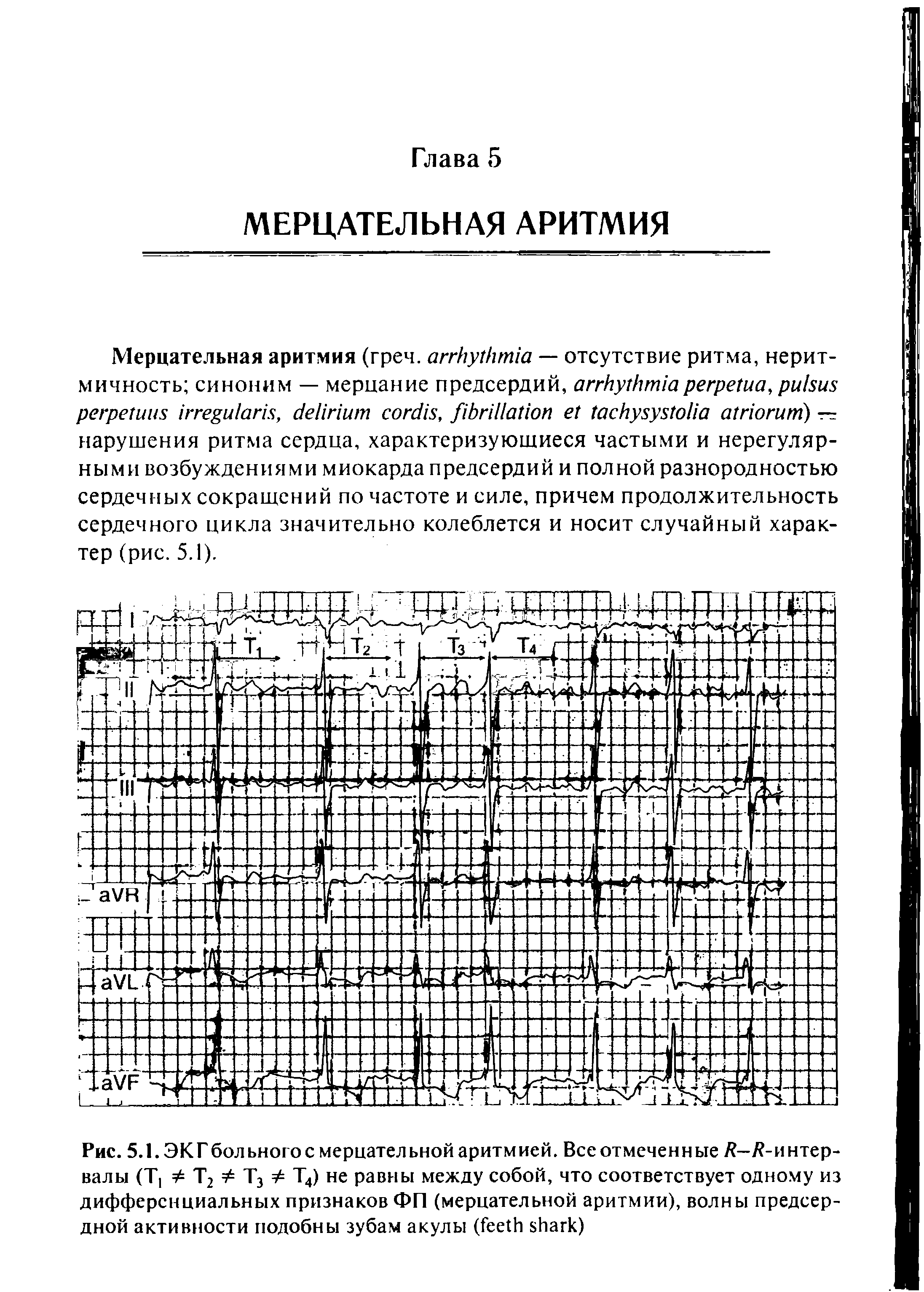 Рис. 5.1. ЭКГбольного с мерцательной аритмией. Все отмеченные Я-/ -интер-валы (Т] Т2 Т3 = Т4) не равны между собой, что соответствует одному из дифференциальных признаков ФП (мерцательной аритмии), волны предсердной активности подобны зубам акулы ( )...