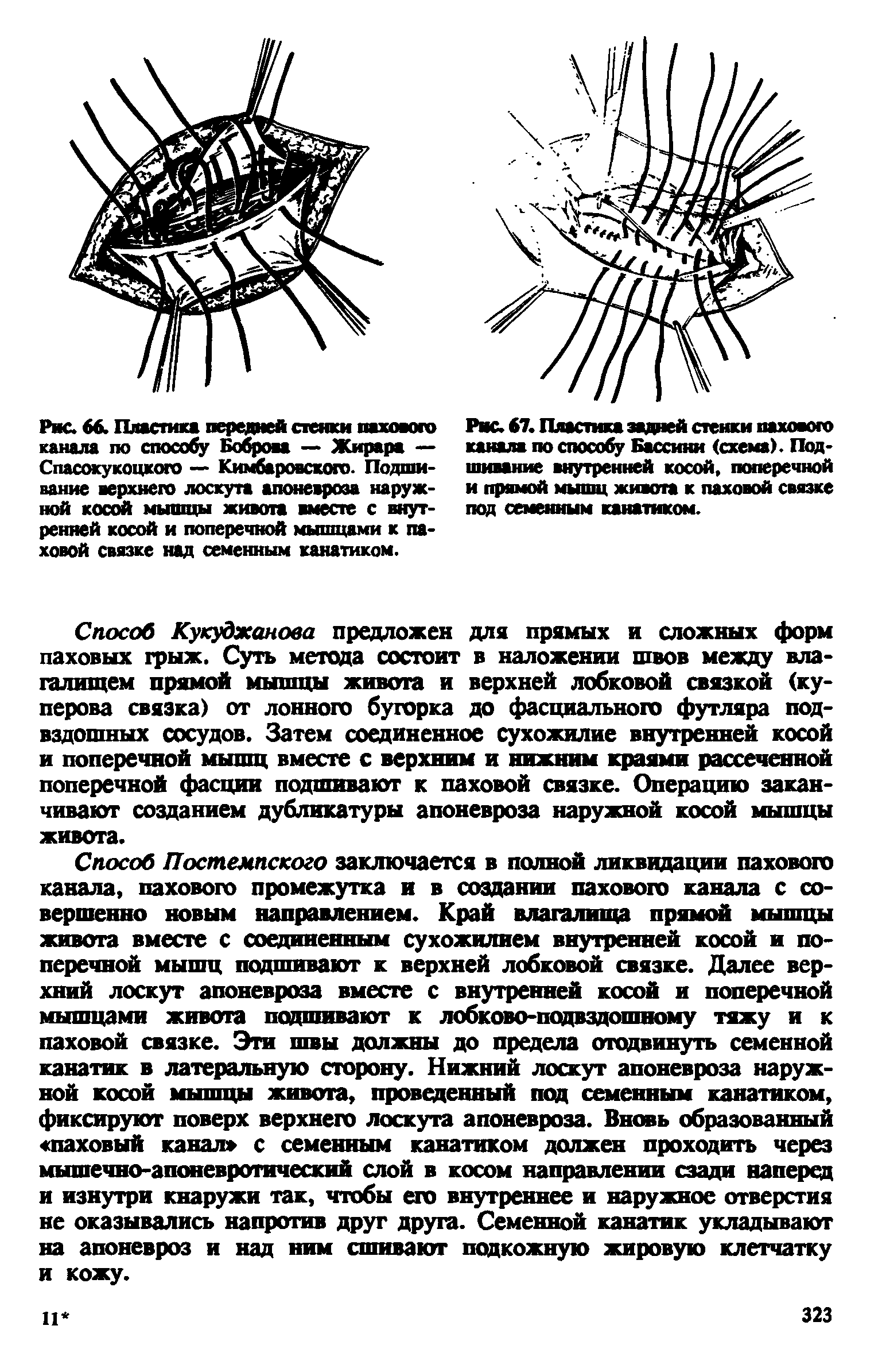 Рис. 67. Пластика задней стенки пахового канала по способу Бассини (схема). Подшивание внутренней косой, поперечной и прямой мышц живота к паховой связке под семенным канатиком.