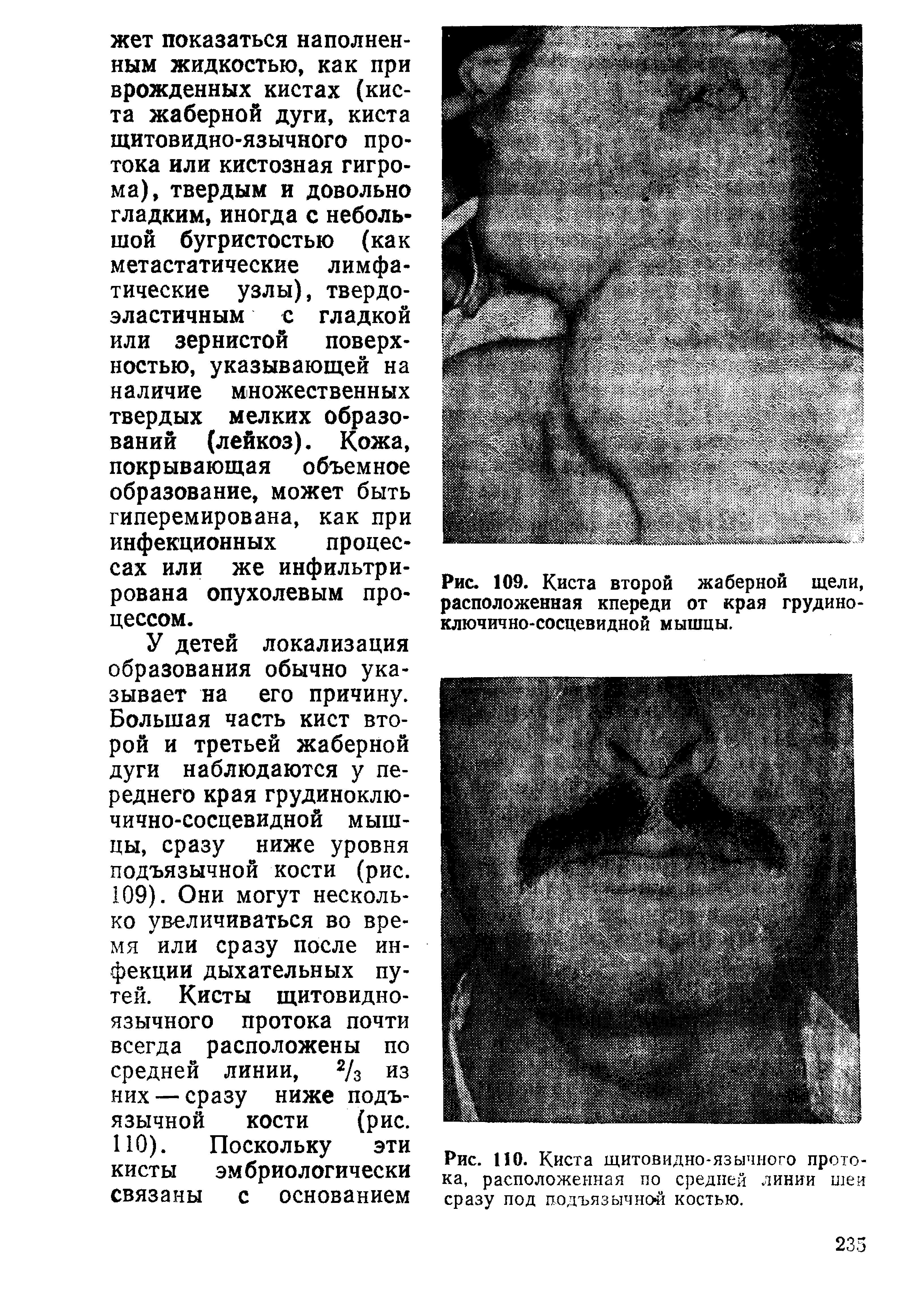 Рис. 110. Киста щитовидно-язычного протока, расположенная по средней линии шеи сразу под подъязычной костью.