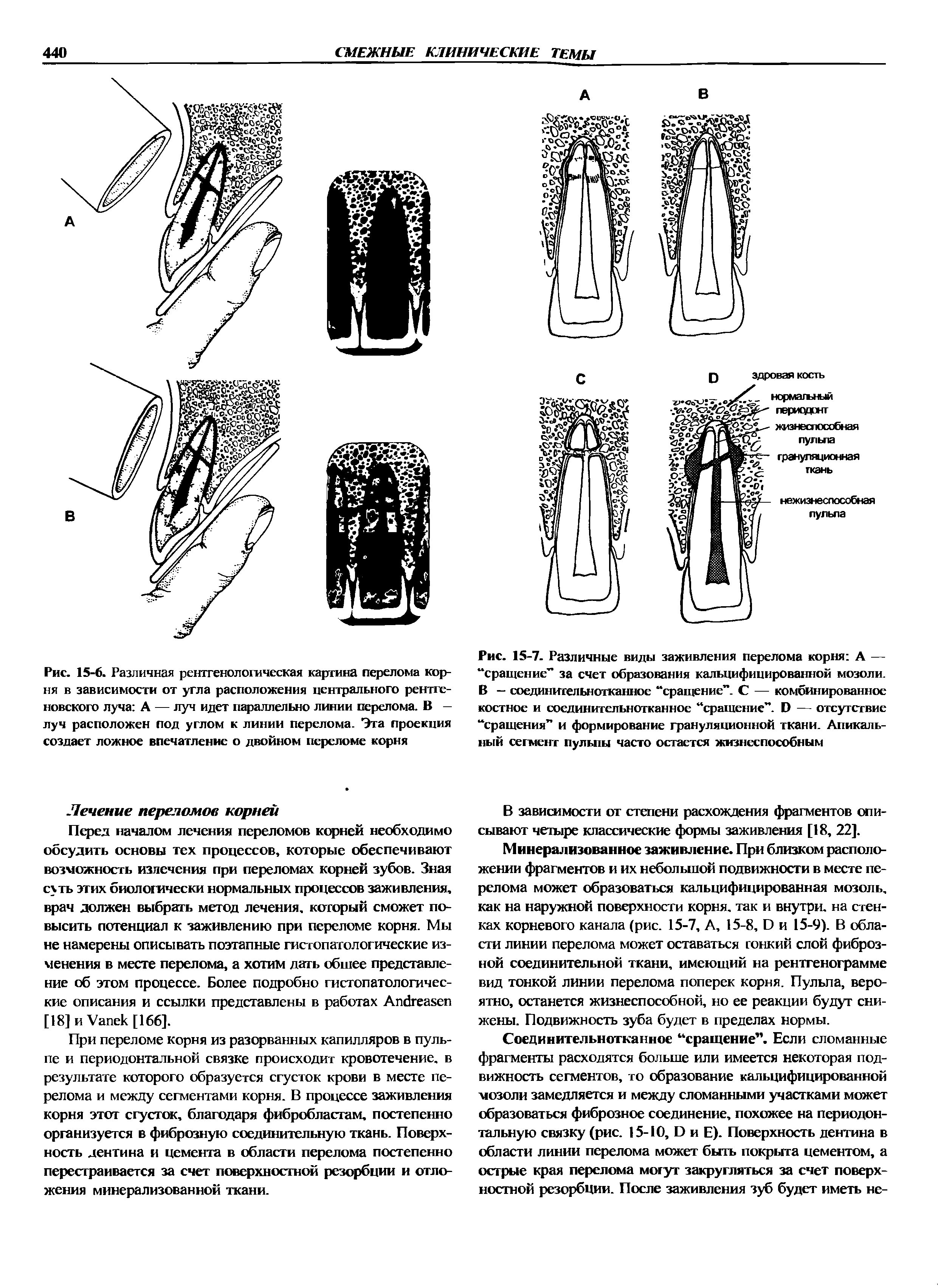 Рис. 15-7. Различные виды заживления перелома корня А — сращение за счет образования кальцифицированной мозоли. В — соединительнотканное сращение . С — комбинированное костное и соединительнотканное сращение . Б — отсутствие сращения и формирование грануляционной ткани. Апикальный сегмент пульпы часто остается жизнеспособным...