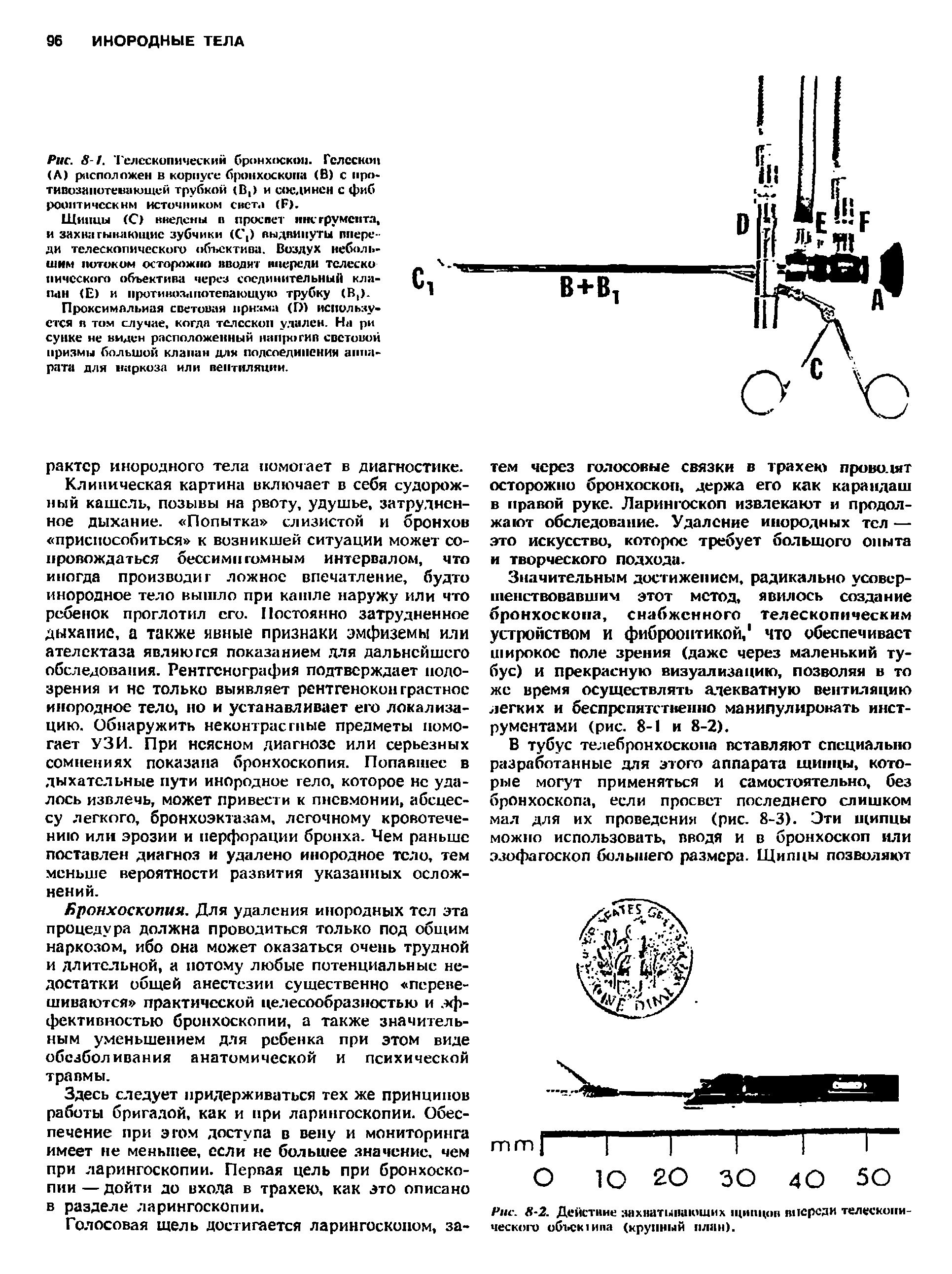 Рис. 8-1. Телескопический бронхоскоп. Телескоп (А) расположен в корпусе бронхоскопа (В) с иро-тивозннотешиищей трубкой (В,) и соединен с фиб рооитнчсскнм ИСТОЧНИКОМ СНСТ.1 (Г),...