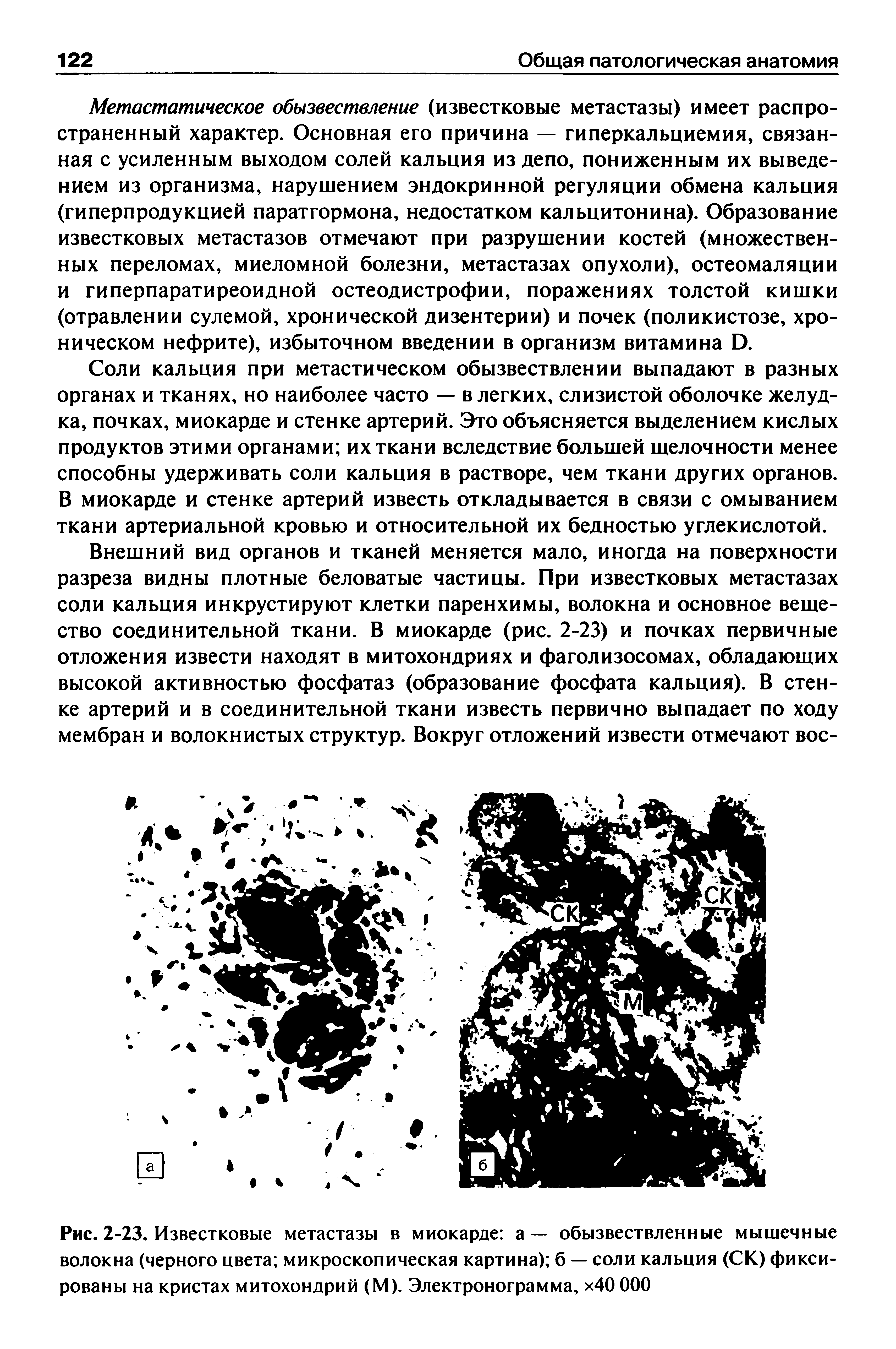 Рис. 2-23. Известковые метастазы в миокарде а — обызвествленные мышечные волокна (черного цвета микроскопическая картина) б — соли кальция (СК) фиксированы на кристах митохондрий (М). Электронограмма, х40 ООО...