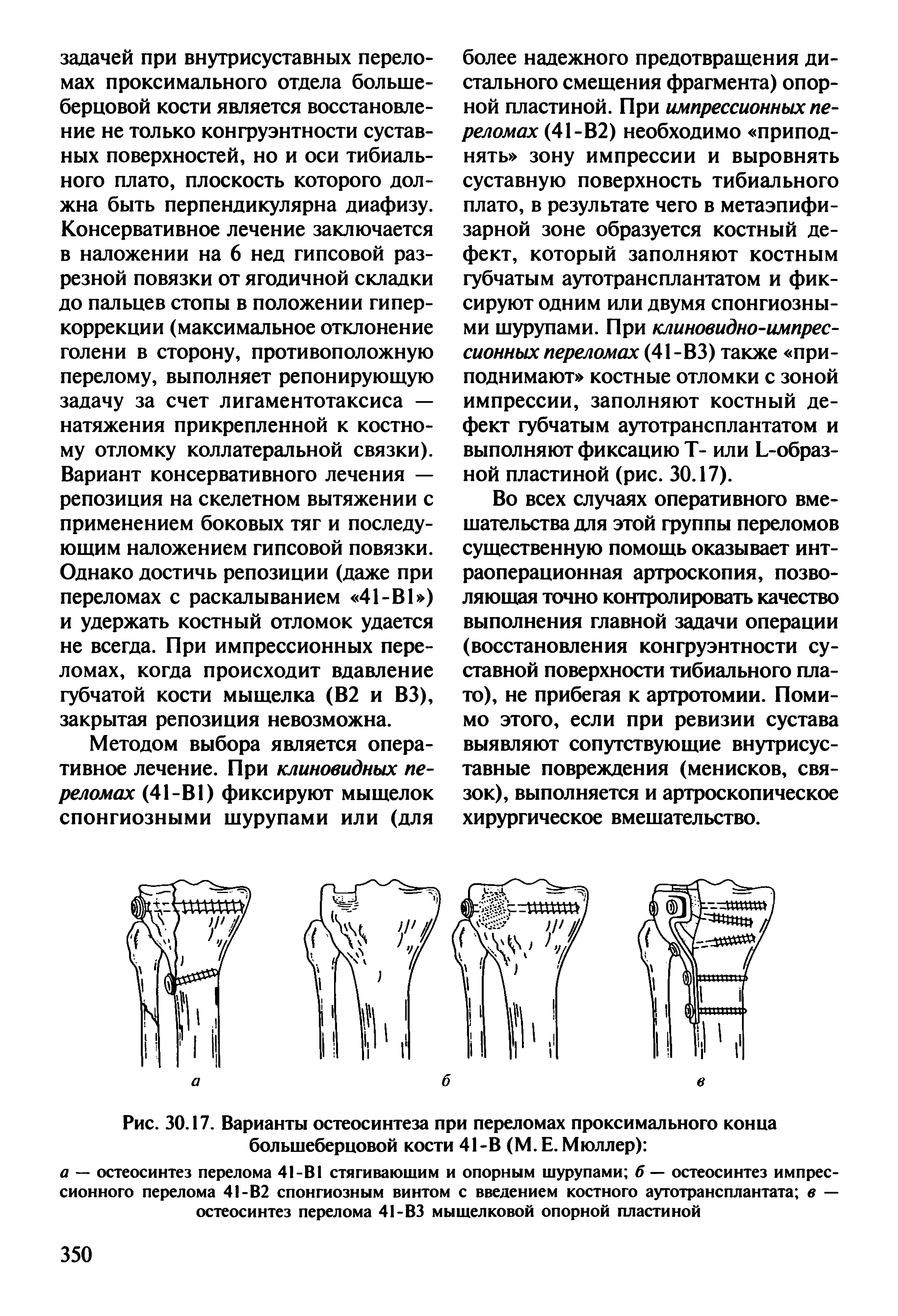 Рис. 30.17. Варианты остеосинтеза при переломах проксимального конца большеберцовой кости 41-В (М. Е. Мюллер) ...