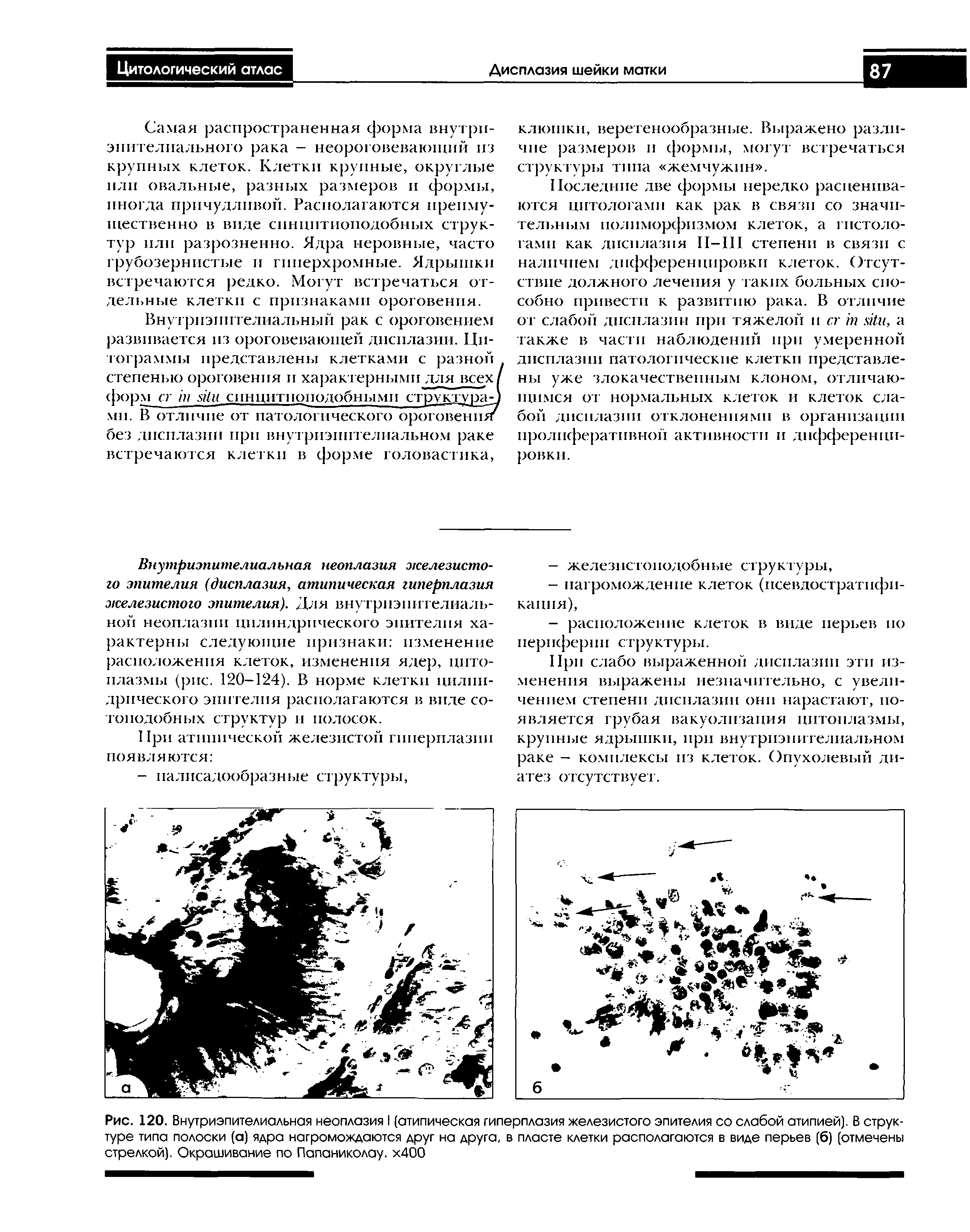 Рис. 120. Внутриэпителиальная неоплазия I (атипическая гиперплазия железистого эпителия со слабой атипией). В структуре типа полоски (а) ядра нагромождаются друг на друга, в пласте клетки располагаются в виде перьев (б) (отмечены стрелкой). Окрашивание по Папаниколау. х400...