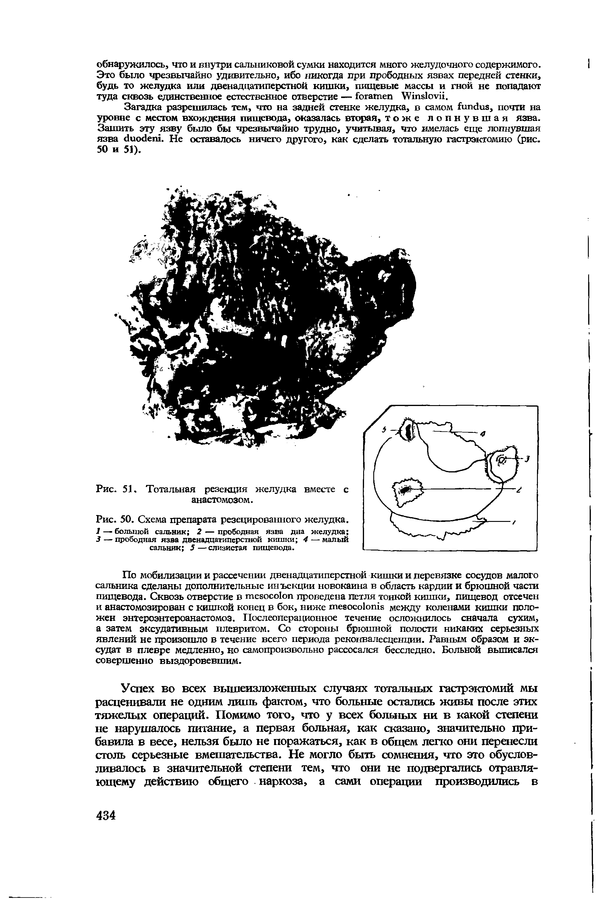 Рис. 50. Схема препарата резецированного желудка. / — большой сальник 2 — прободная язва дна желудка 3 — прободная язва двенадцатиперстной кишки 4 — малый сальник 5 —слизистая пищевода.