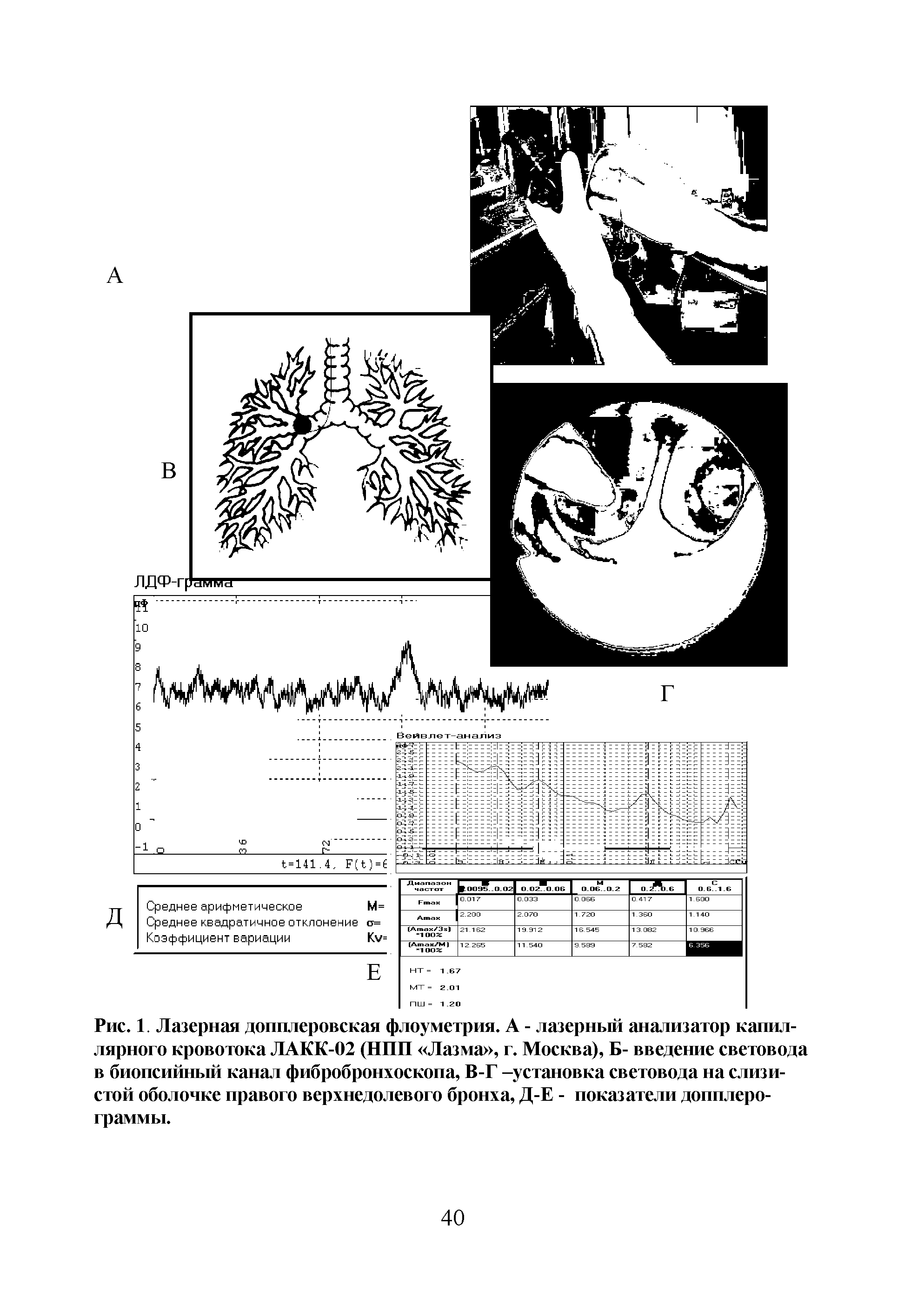 Рис. 1. Лазерная допплеровская флоуметрия. А - лазерный анализатор капиллярного кровотока ЛАКК-02 (НПП Лазма , г. Москва), Б- введение световода в биопсийный канал фибробронхоскопа, В-Г -установка световода на слизистой оболочке правого верхнедолевого бронха, Д-Е - показатели допплеро-граммы.