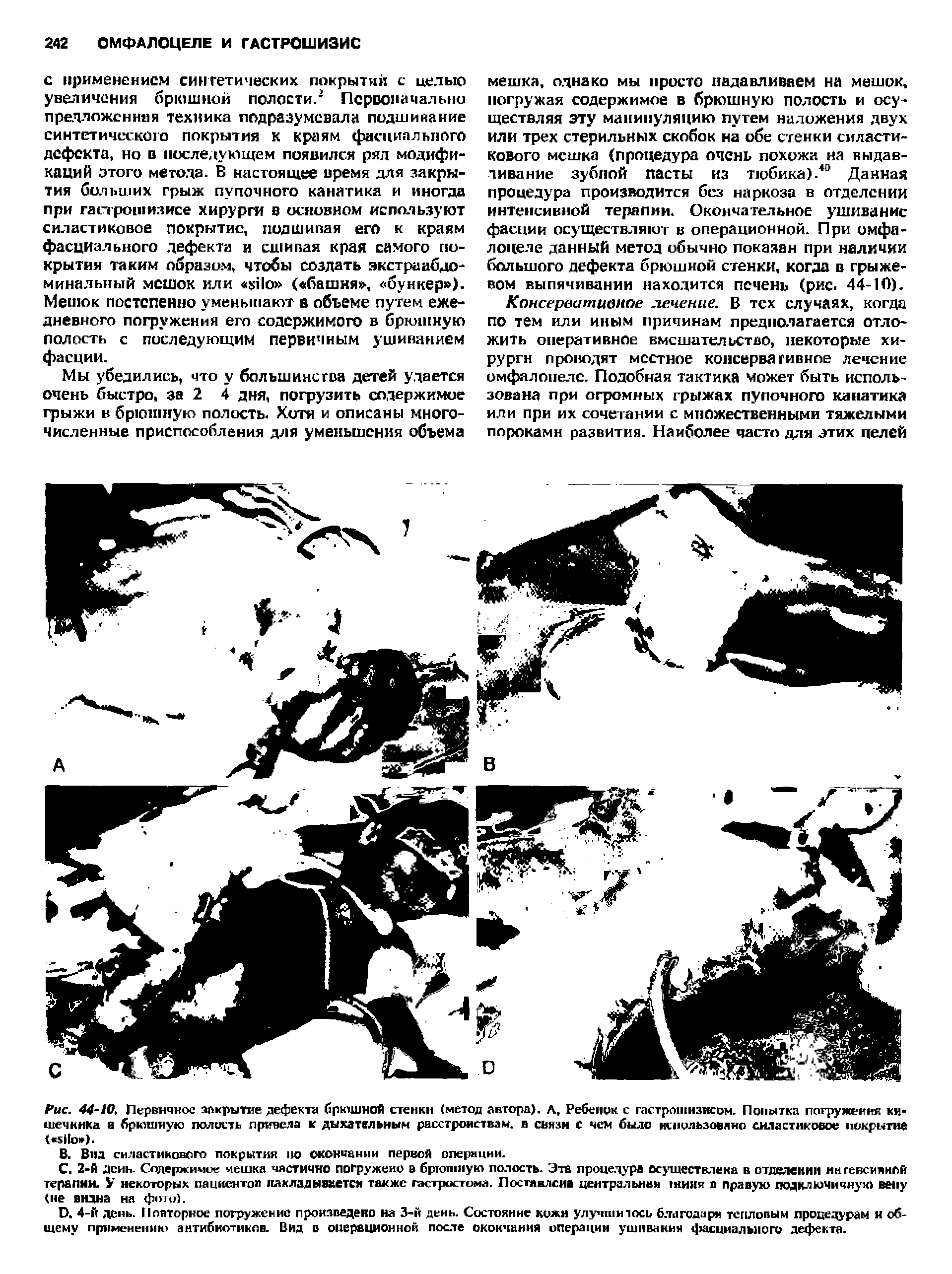 Рис. 44-10. Первичное закрытие дефекта брюшной стенки (метод автора). А, Ребенок с гастрошизисом. Попытка погружения кишечника а брюшную полость привела к дыхательным расстройствам, в связи с чем было использовано силастиковое покрытие ( ).