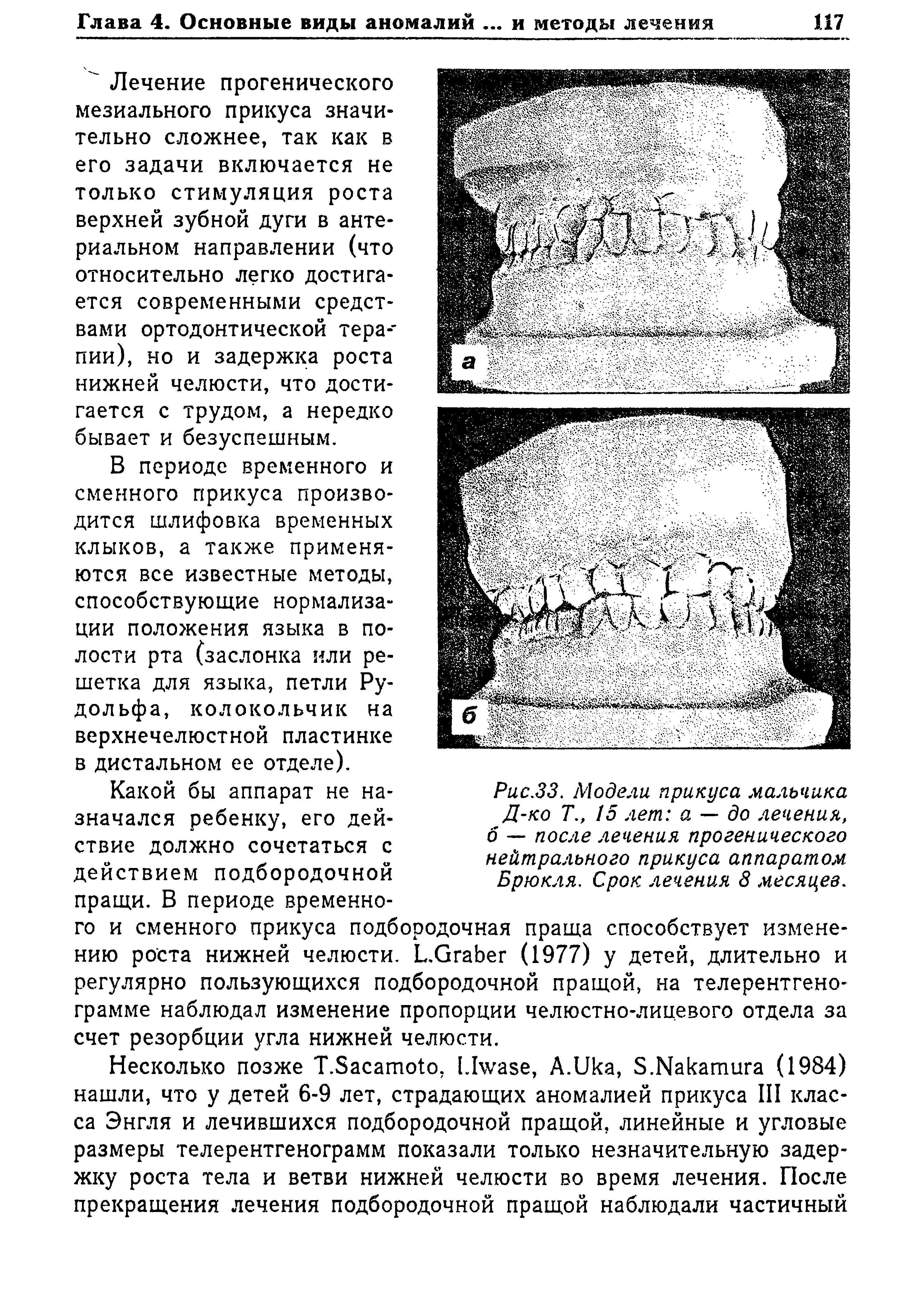 Рис.ЗЗ. Модели прикуса мальчика Д-ко Т., 15 лет а — до лечения, б — после лечения прогенического нейтрального прикуса аппаратом Брюкля, Срок лечения 8 месяцев.