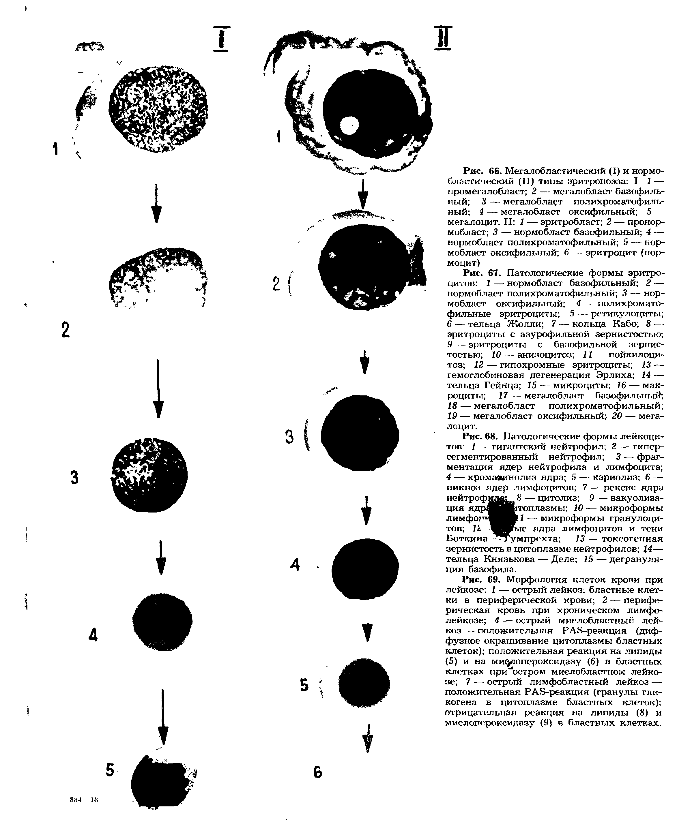Рис. 67. Патологические формы эритроцитов 1 — нормобласт базофильный 2 — нормобласт полихроматофильный 3 — нормобласт оксифильный 4 — полихроматофильные эритроциты 5 — ретикулоциты 6 — тельца Жолли 7 — кольца Кабо 8 —...