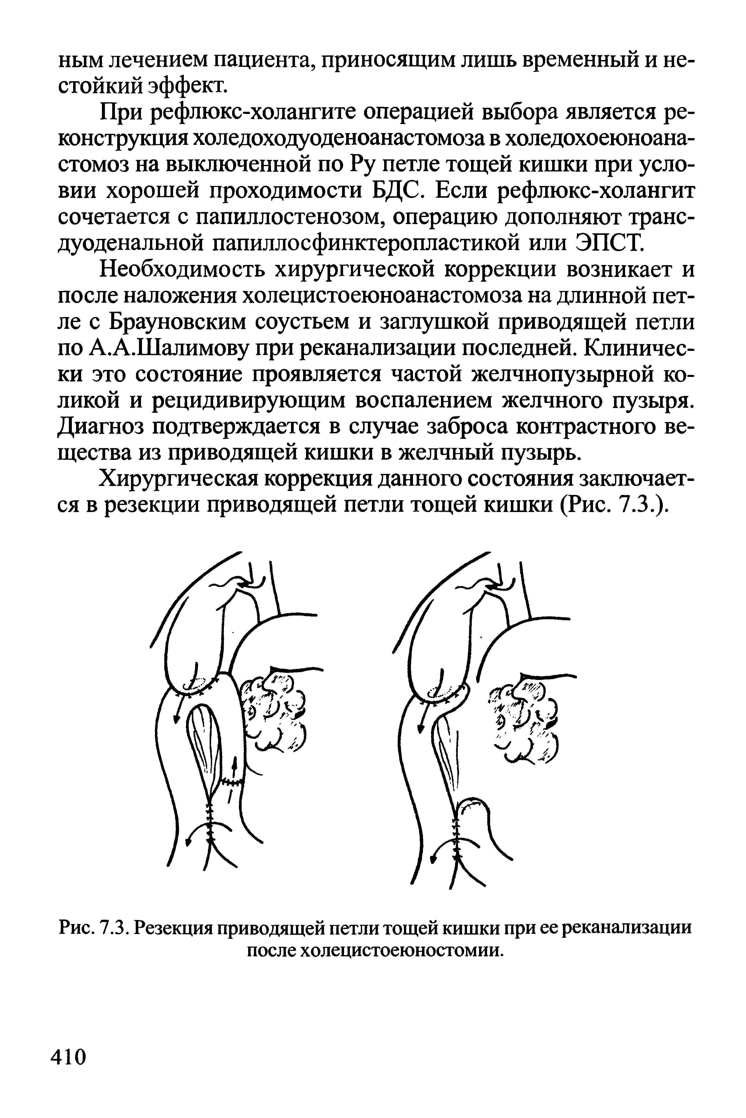 Рис. 7.3. Резекция приводящей петли тощей кишки при ее реканализации после холецистоеюностомии.