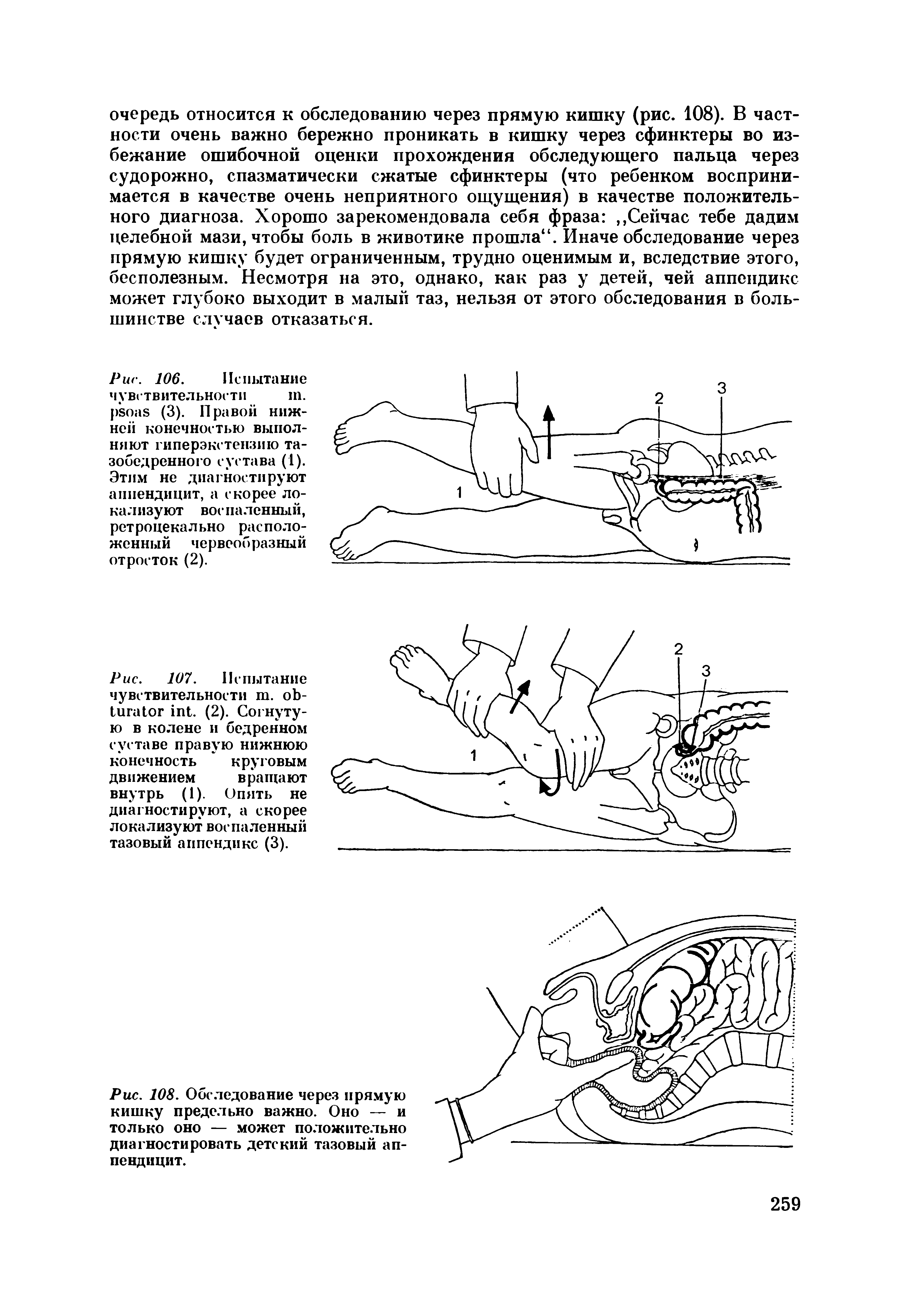 Рис. 108. Обследование через прямую кишку предельно важно. Оно — и только оно — может положительно диагностировать детский тазовый аппендицит.